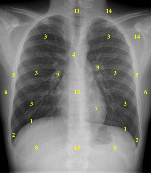 Approach To The Chest X Ray Cxr Undergraduate Diagnostic Imaging