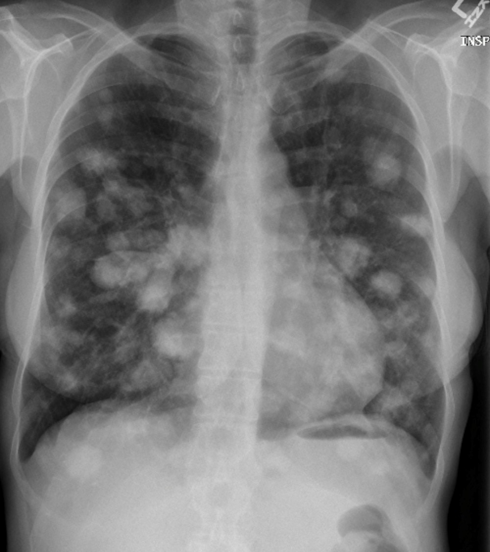 Frontal Chest Radiograph Demonstrates Multiple Lung Nodules The Hot