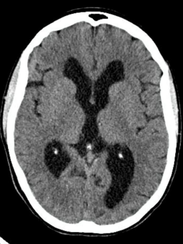 Hydrocephalus Undergraduate Diagnostic Imaging Fundamentals