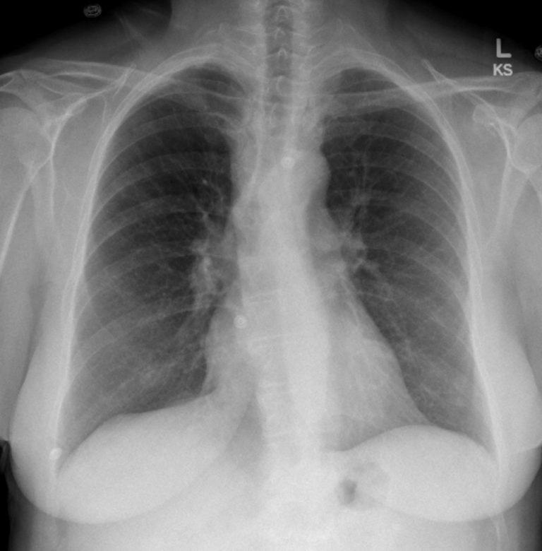 Pulmonary Thromboembolism Undergraduate Diagnostic Imaging Fundamentals