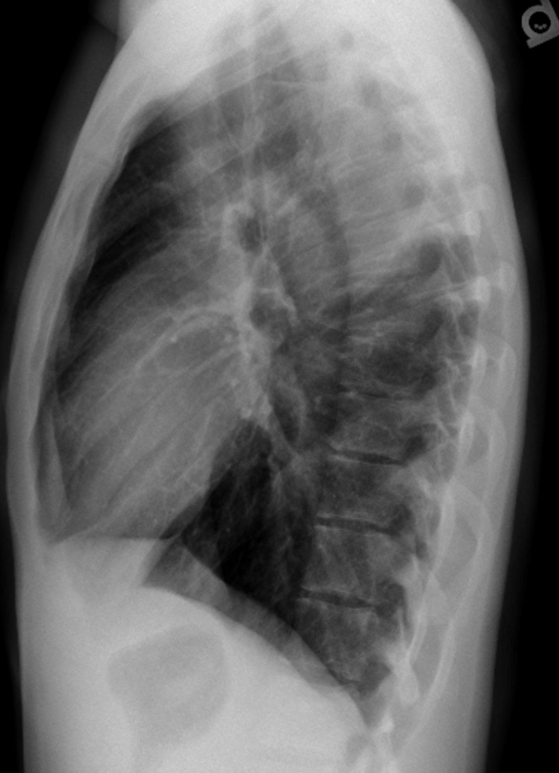 Pneumothorax Undergraduate Diagnostic Imaging Fundamentals