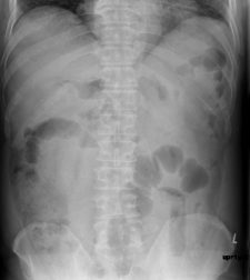 Ileus Undergraduate Diagnostic Imaging Fundamentals