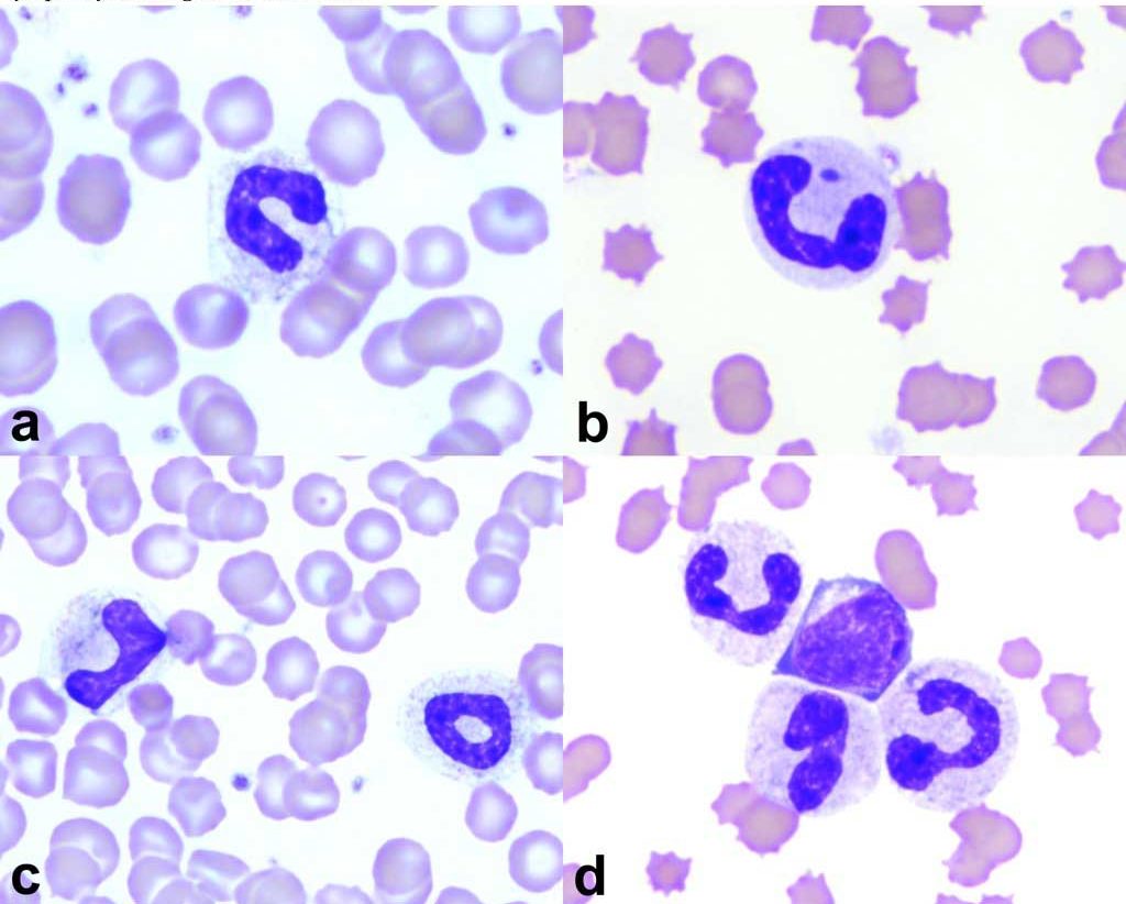 Figure 2.4 Examples of toxic change in canine neutrophils: a. foamy vacuolation and blue granularity in the cytoplasm of a band neutrophil, b. bluish cytoplasm containing a Döhle body in a neutrophil, c. vacuolation and blue granularity in the cytoplasms of two band neutrophils, d. vacuolation and blue granularity in the cytoplasms of two neutrophils and one band neutrophil; the fourth cell is a reactive lymphocyte. Wright-Giemsa stain.