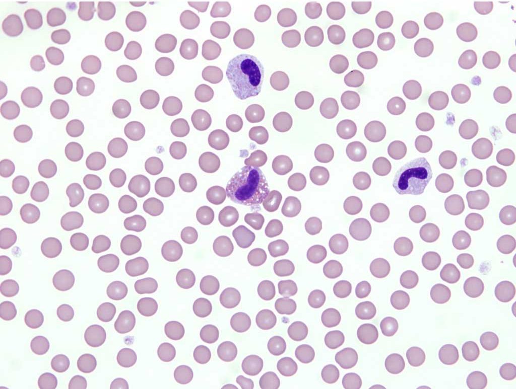 Figure 2.7 Pelger-Huët anomaly in a dog. Note the immaturity of the nuclei (metamyelocyte and band) in the neutrophils and the eosinophil, despite the mature cytoplasm. Granulocyte function is not affected and the anomaly is generally an incidental finding. Wright-Giemsa stain.