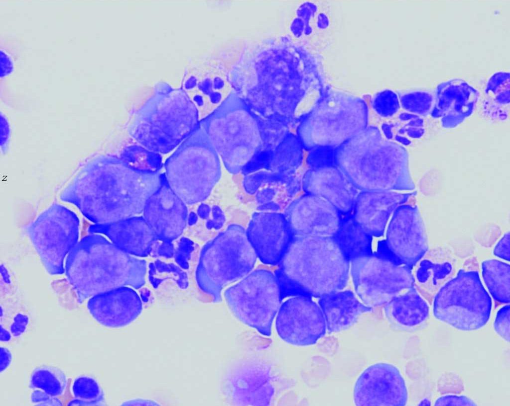 Figure 3.11 Cytospin preparation of pleural fluid from a dog with thoracic lymphosarcoma. The neoplastic lymphocytes are much larger than the erythrocytes and granulocytes in the field. A few small lymphocytes are also present for comparison. Prominent nucleoli are present within many nuclei and cytoplasms are generally very darkly stained. Wright-Giemsa stain.