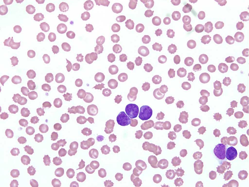 Figure 3.13 Blood film from Prince, a 1-year-old Golden Retriever dog. Although the lymphocyte count is only high normal, circulating lymphocytes are large, darkly stained, and nucleoli are prominent (not visible at this magnification) suggesting a neoplastic process, particularly along paws with other laboratory findings. Note the presence of keratocytes and schizocytes suggesting fibrin strand/ microvascular injury to erythrocytes. See case 4 for additional findings. Wright-Giemsa stain.