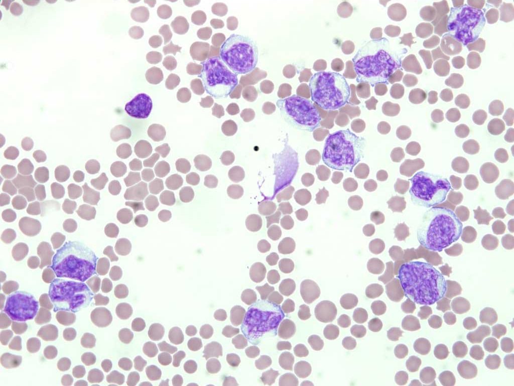 Figure 3.2 Blood film from a dog with acute lymphocytic/lymphoblastic leukemia (ALL). Note the size of the neoplastic cells relative to the erythrocytes. Nuclear chromatin is coarse, clumped, and large nucleoli are present. Two ruptured cells are present in the field. Wright-Giemsa stain.