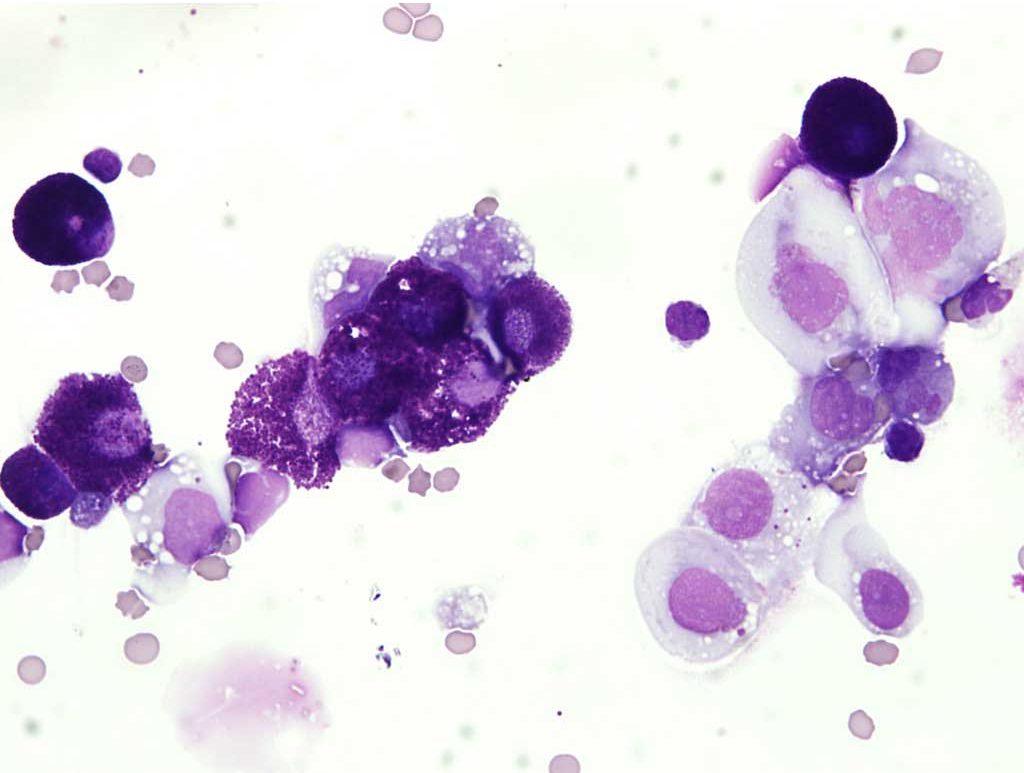 Figure 3.9 Abdominal fluid from a cat with systemic mast cell neoplasia involving spleen, liver, and bone marrow. The large cells with pale cytoplasms are macrophages, some of which are phagocytosing free mast cell granules. Wright-Giemsa stain.