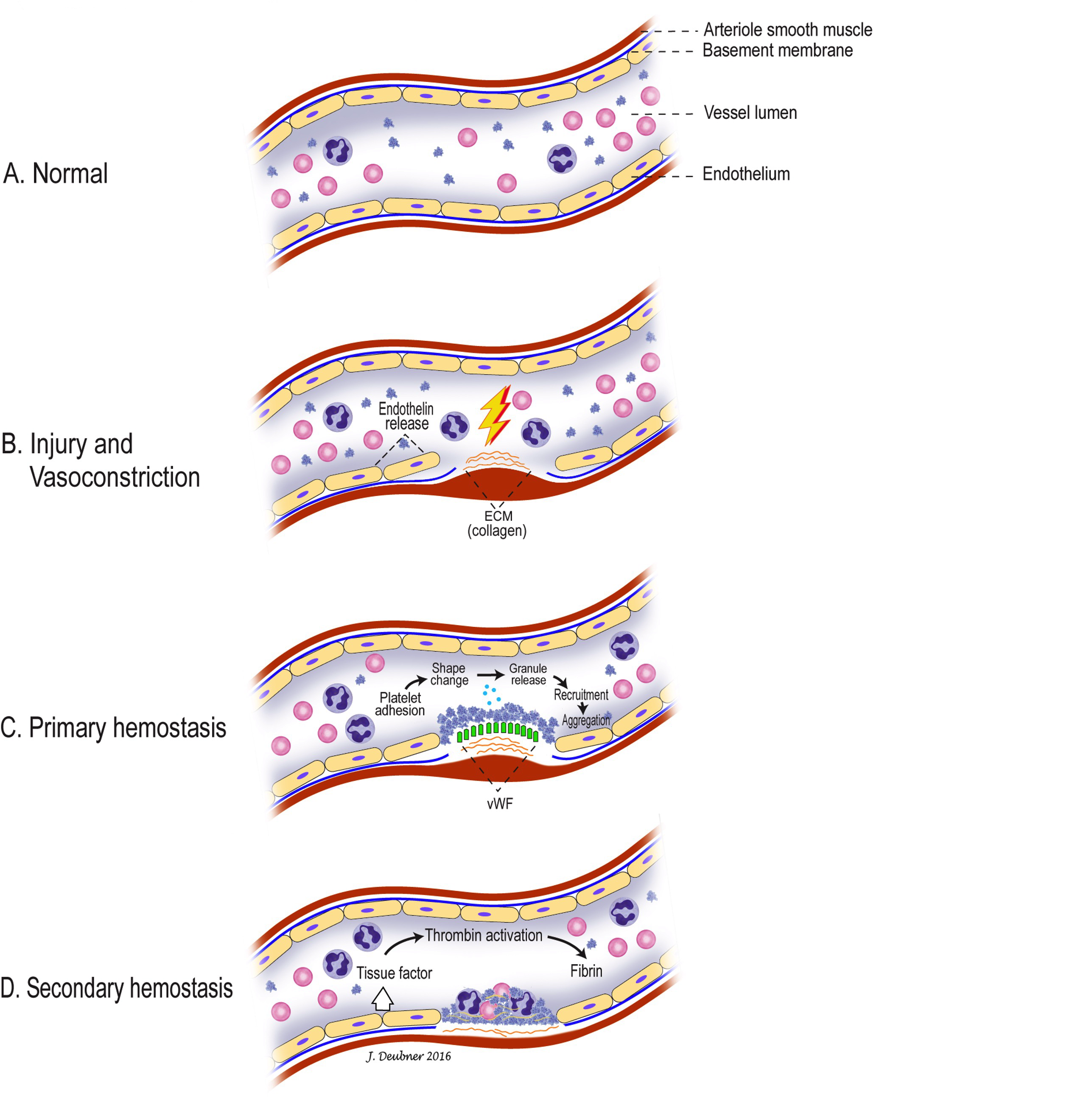 Figure 4.1 Hemostasis. A. Normal undamaged blood vessel. B. Transient vasoconstriction occurs at site of vascular injury through the action of endothelin and similar molecules as well as neural factors. C. Platelets adhere to damaged endothelium/subendothelium. Adhesion is strengthened through subendothelial/collagen-bound von Willebrand factor (vWF) binding to its receptor on the platelet surface. Platelets undergo shape change, release of granule contents, and aggregation, forming the primary hemostatic plug.D. Tissue factor is released and other coagulation factors are activated. Ultimately, this results in formation of the secondary/stable hemostatic plug through fibrin deposition and polymerization on local phospholipid surfaces (mainly platelet surfaces, but also other cells that have been incorporated into the hemostatic plug). ECM=extracellular matrix.