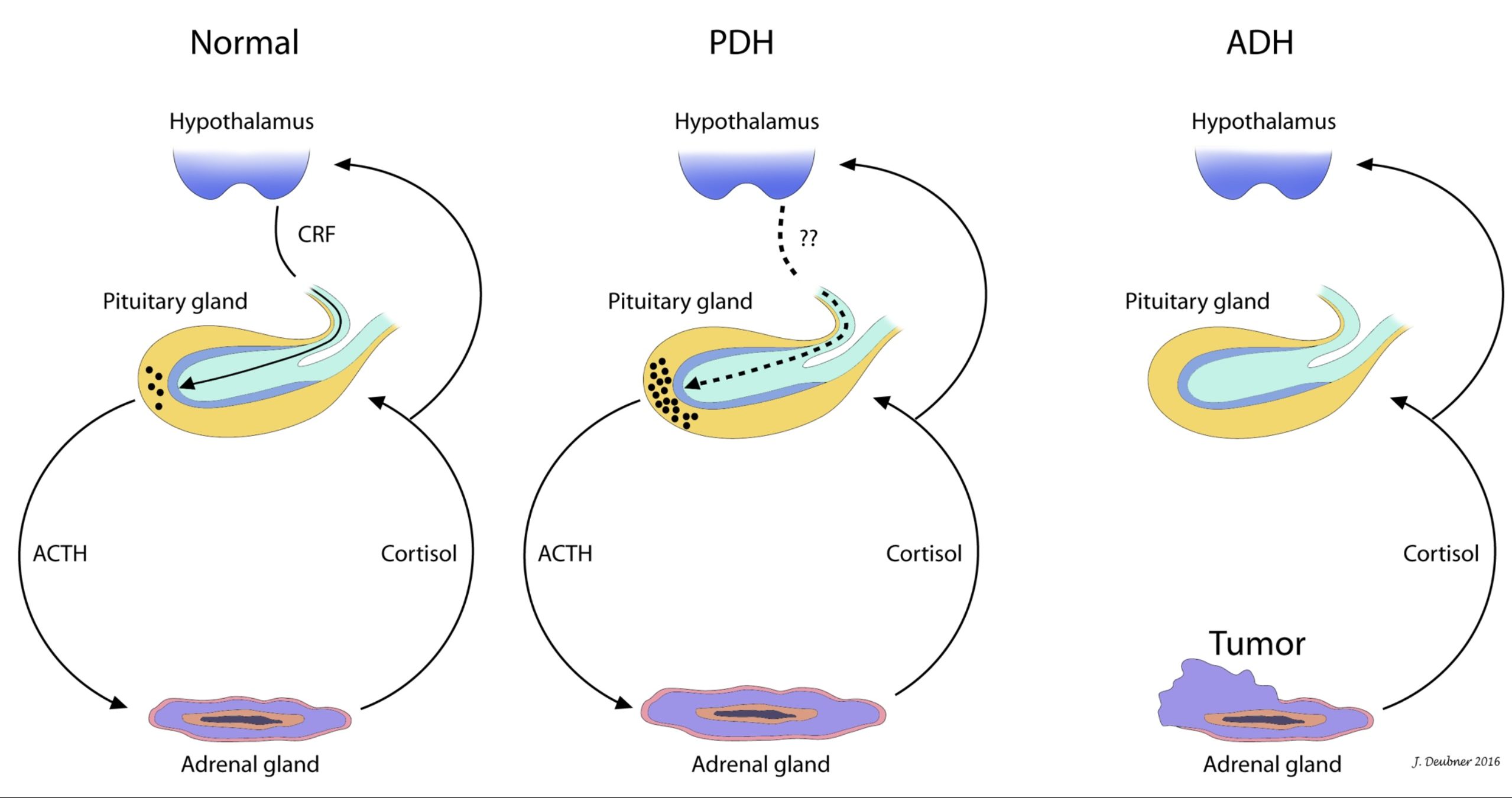 Figure 10.5 Hypothalamic-pituitary-adrenal axis. Left to right: Normal; Pituitary-dependent hyperadrenocorticism (PDH); Adrenal-dependent hyperadrenocorticism (ADH).