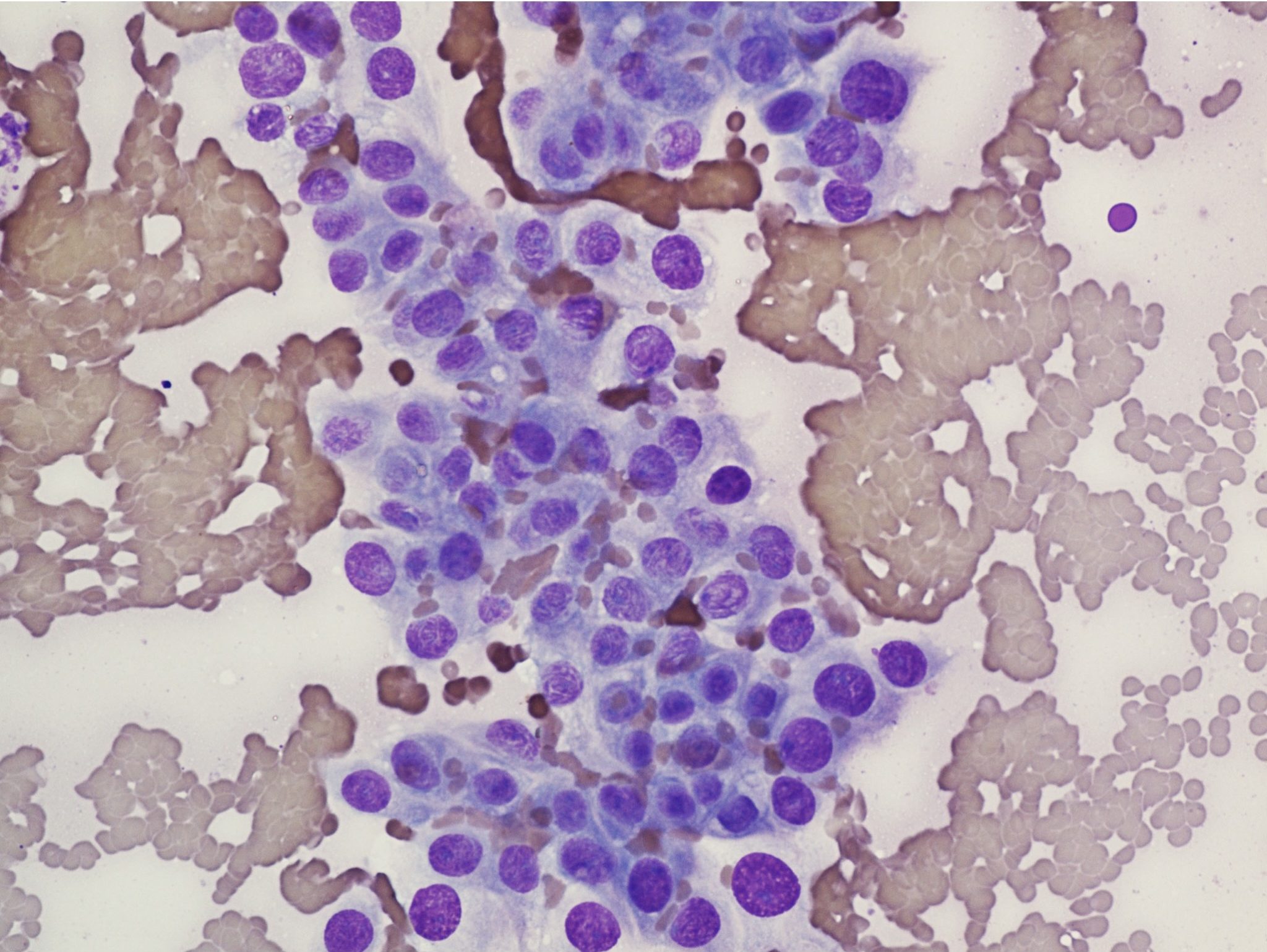 Figure 5.13 Poorly differentiated epithelial cells. The cells display malignant features including anisocytosis and anisokaryosis. (Wright-Giemsa; IP.)