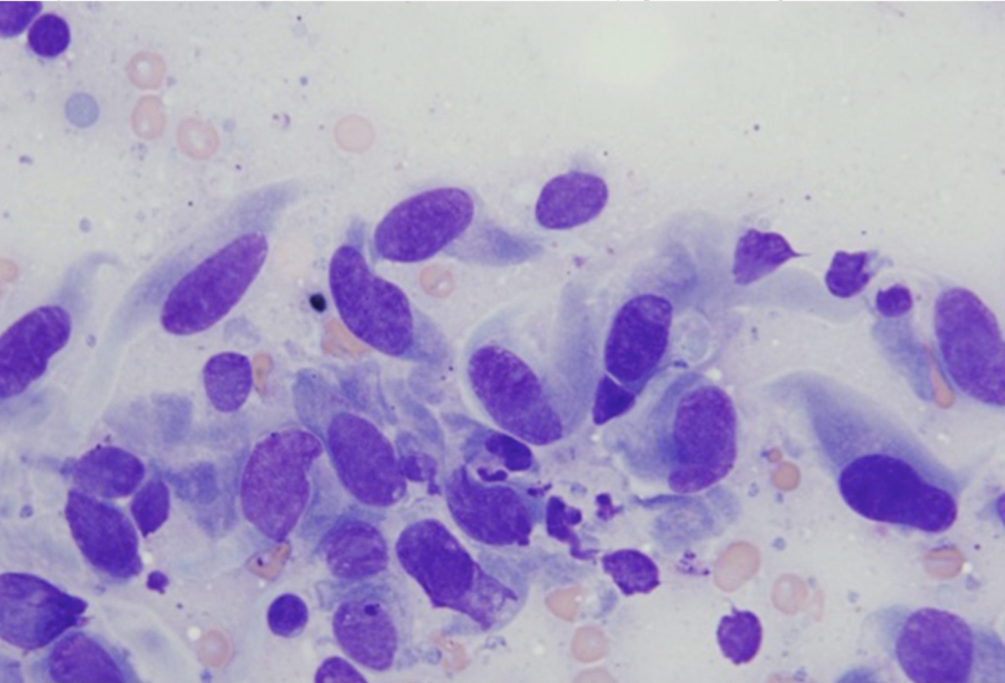 Figure 5.15 Spindle cells with malignant features. The cells are large and often binucleate. These are leiomyosarcoma cells that have metastasized to the mandibular lymph node. (Wright-Giemsa; HP oil.)