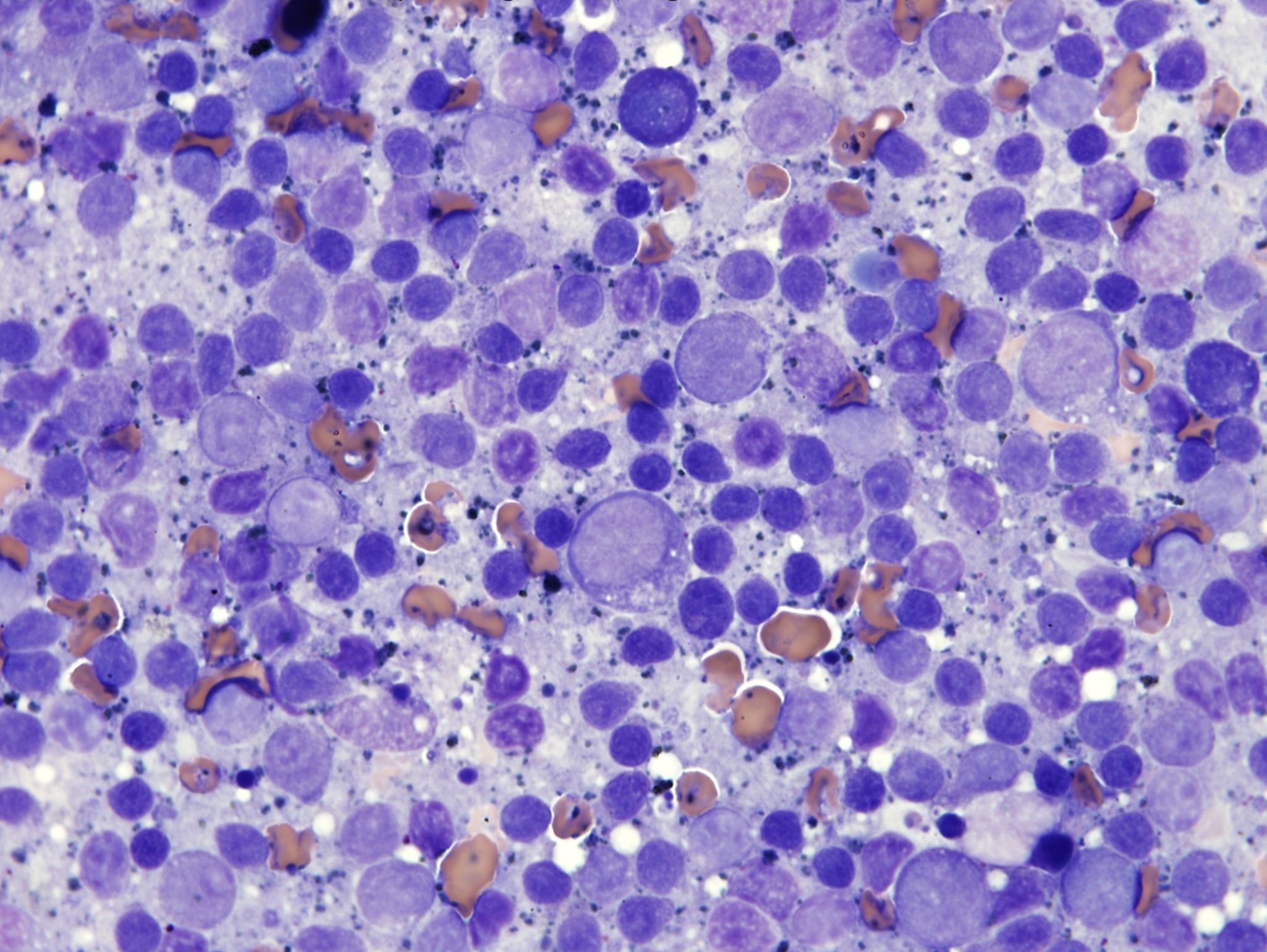 Figure 5.19 Lymphocytes from a fine needle sample of a peripheral lymph node. Most lymphocytes are small and mature with darkly staining nuclei. (Wright-Giemsa; HP oil.)