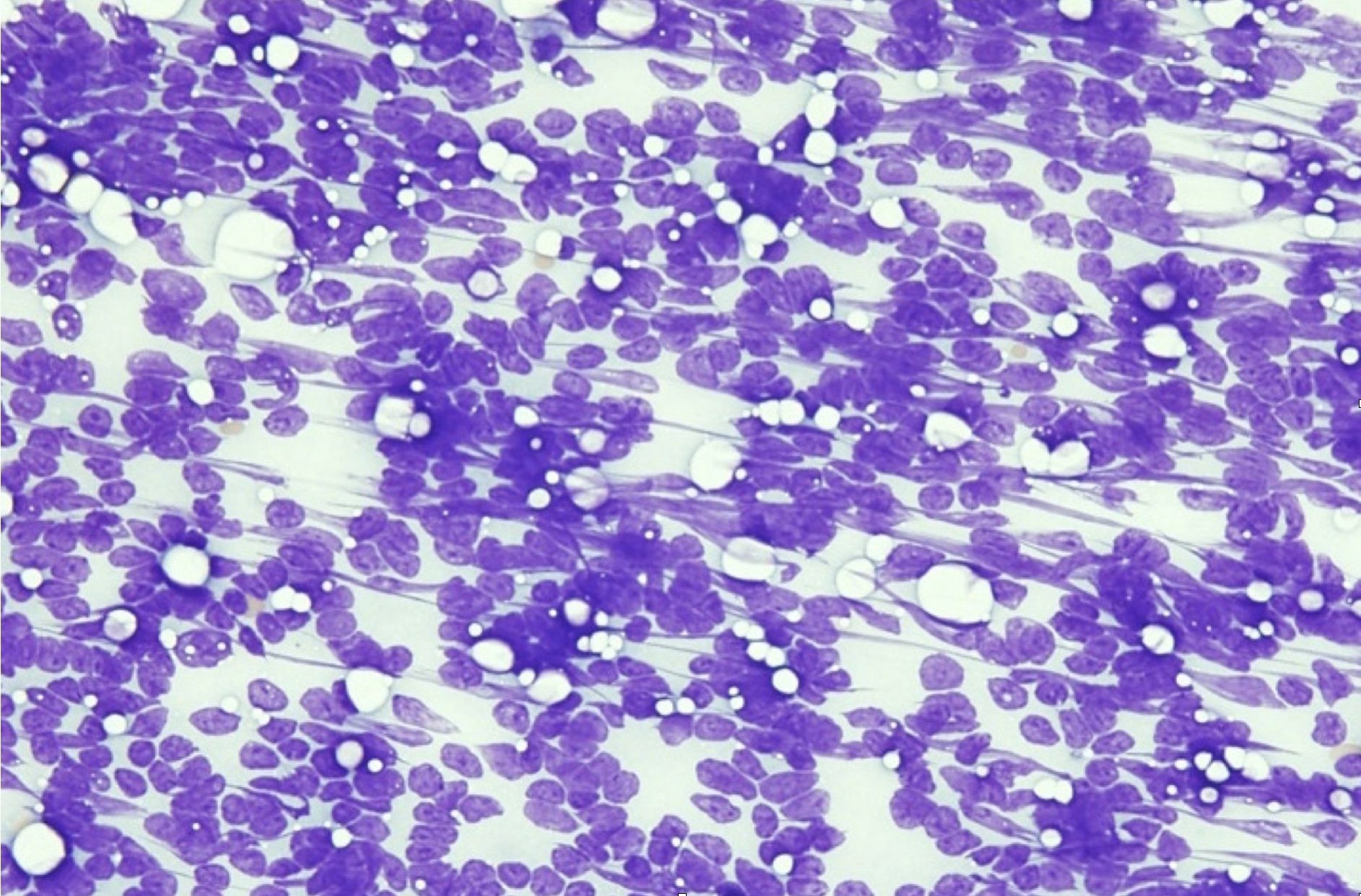 Figure 5.2 Disintegrated cells in a cytology sample. This sample is nondiagnostic. (Wright-Giemsa; IP.) (Image courtesy of Dr. Angelica Galezowski.)