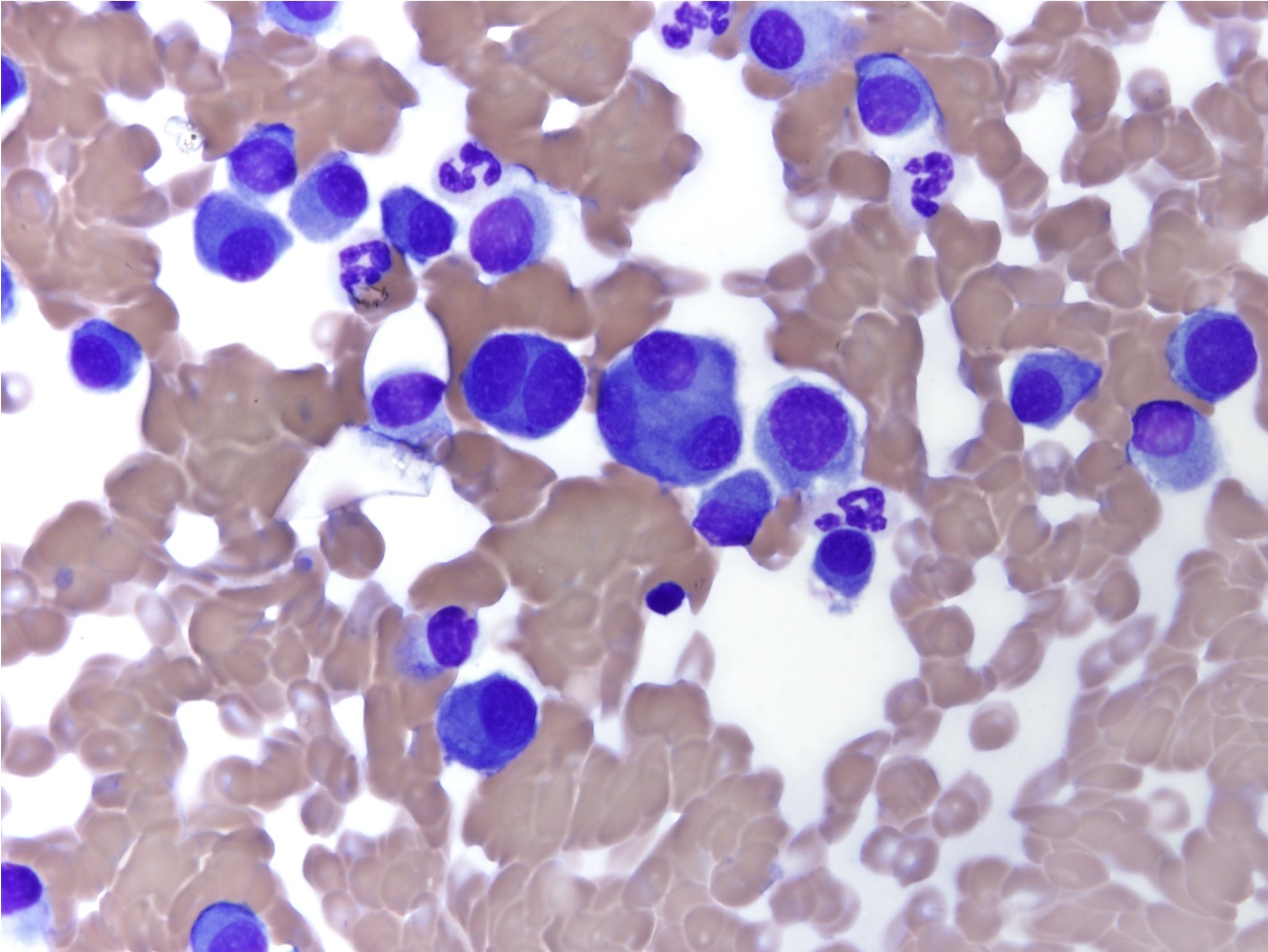 Figure 5.23 Well differentiated plasma cells from a fine needle sample of a solitary cutaneous plasmacytoma. There is 1 binucleate and 1 trinucleate cell. (Wright-Giemsa; HP oil.)