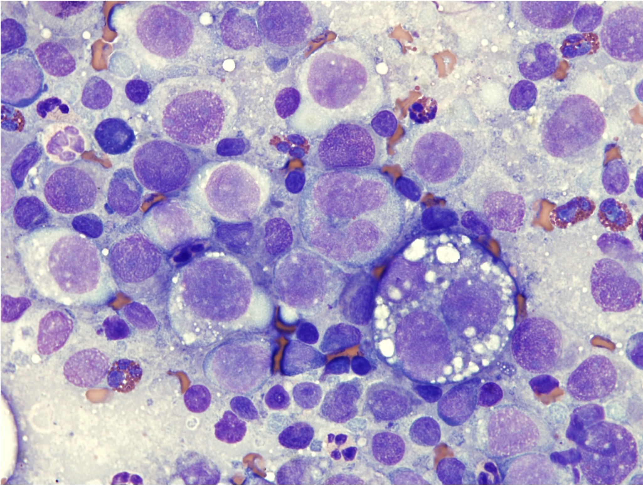 Figure 5.24 Neoplastic histiocytes with many criteria of malignancy (histiocytic sarcoma). (Wright-Giemsa; HP oil.)