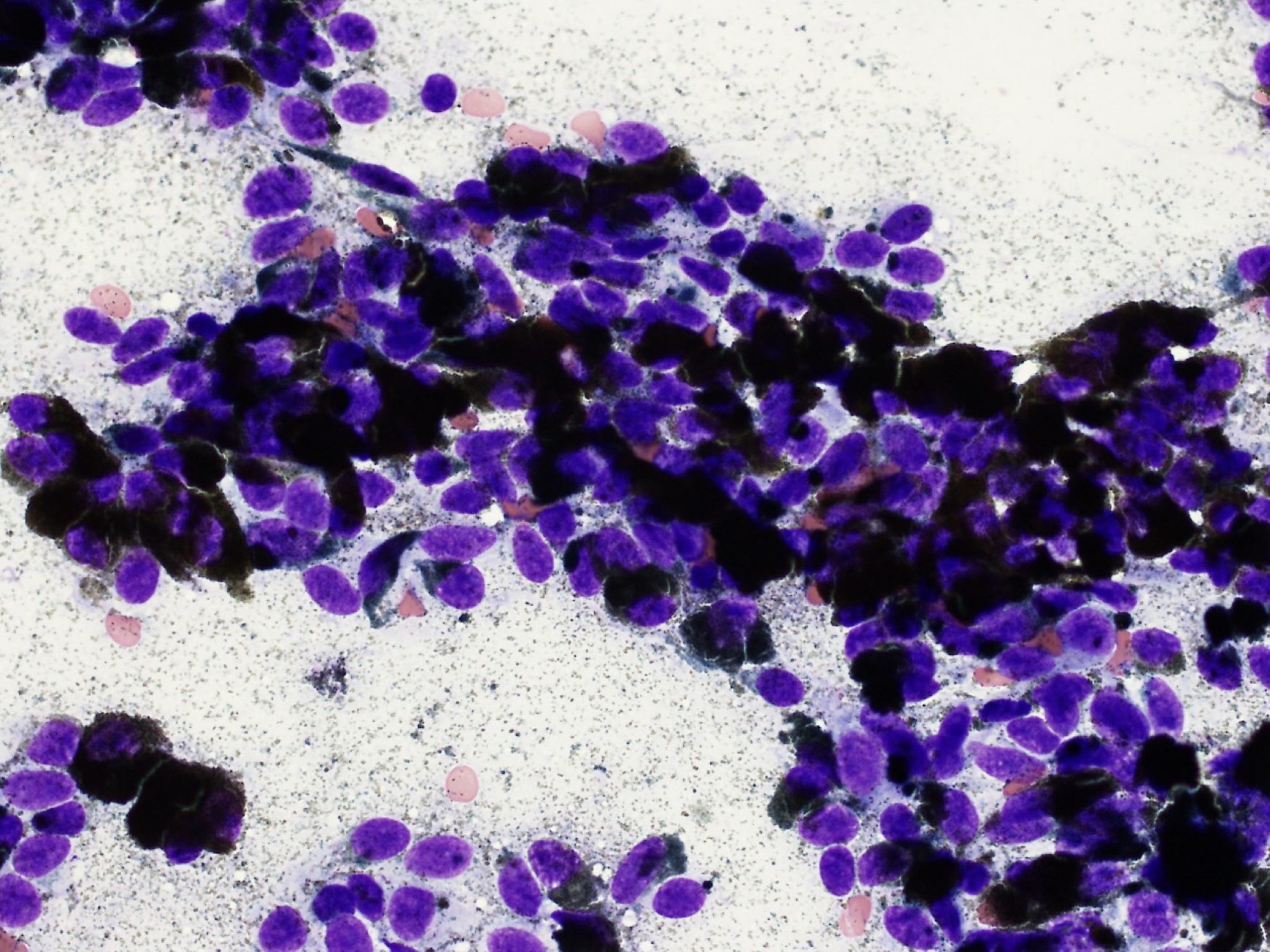 Figure 5.25 Well pigmented melanocytes from a fine needle sample of a dermal melanoma. There are numerous melanin granules in the background as well (Wright-Giemsa; HP oil.) (Image courtesy of Dr.Angelica Galezowski.)