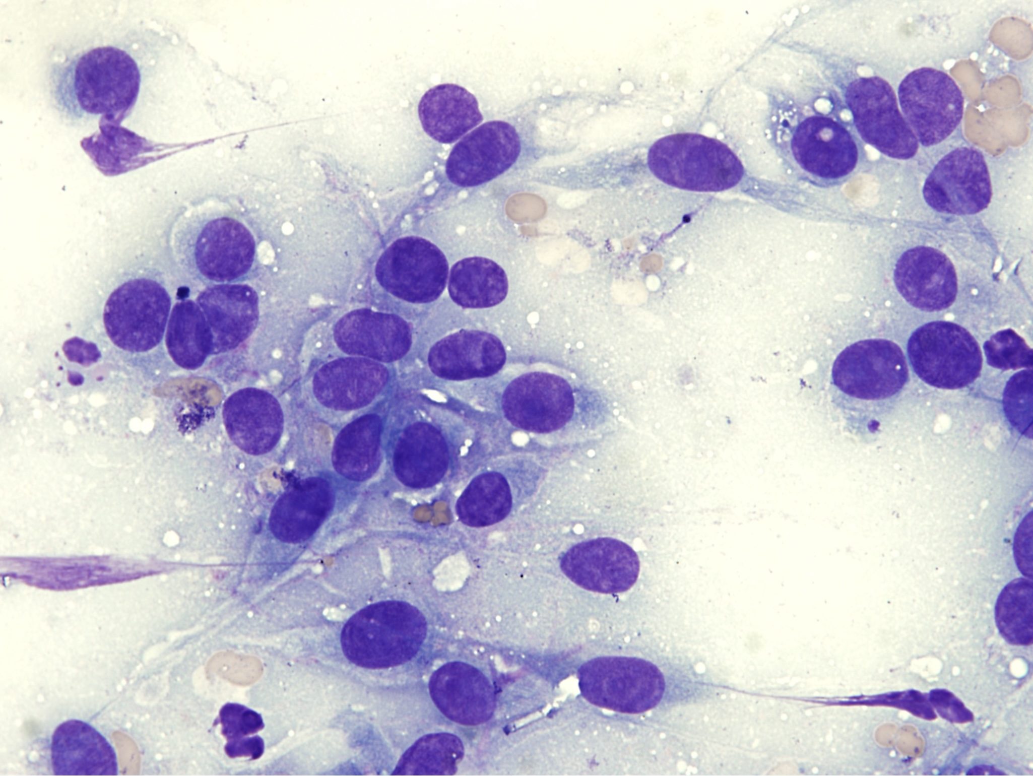 Figure 5.26 Amelanotic melanocytes from an amelanotic malignant melanoma. Cells cannot be confirmed as melanocytes based on this sample; histology and special stains were required. Note variable cell shape (spindle and round). (Wright-Giemsa; HP oil.)