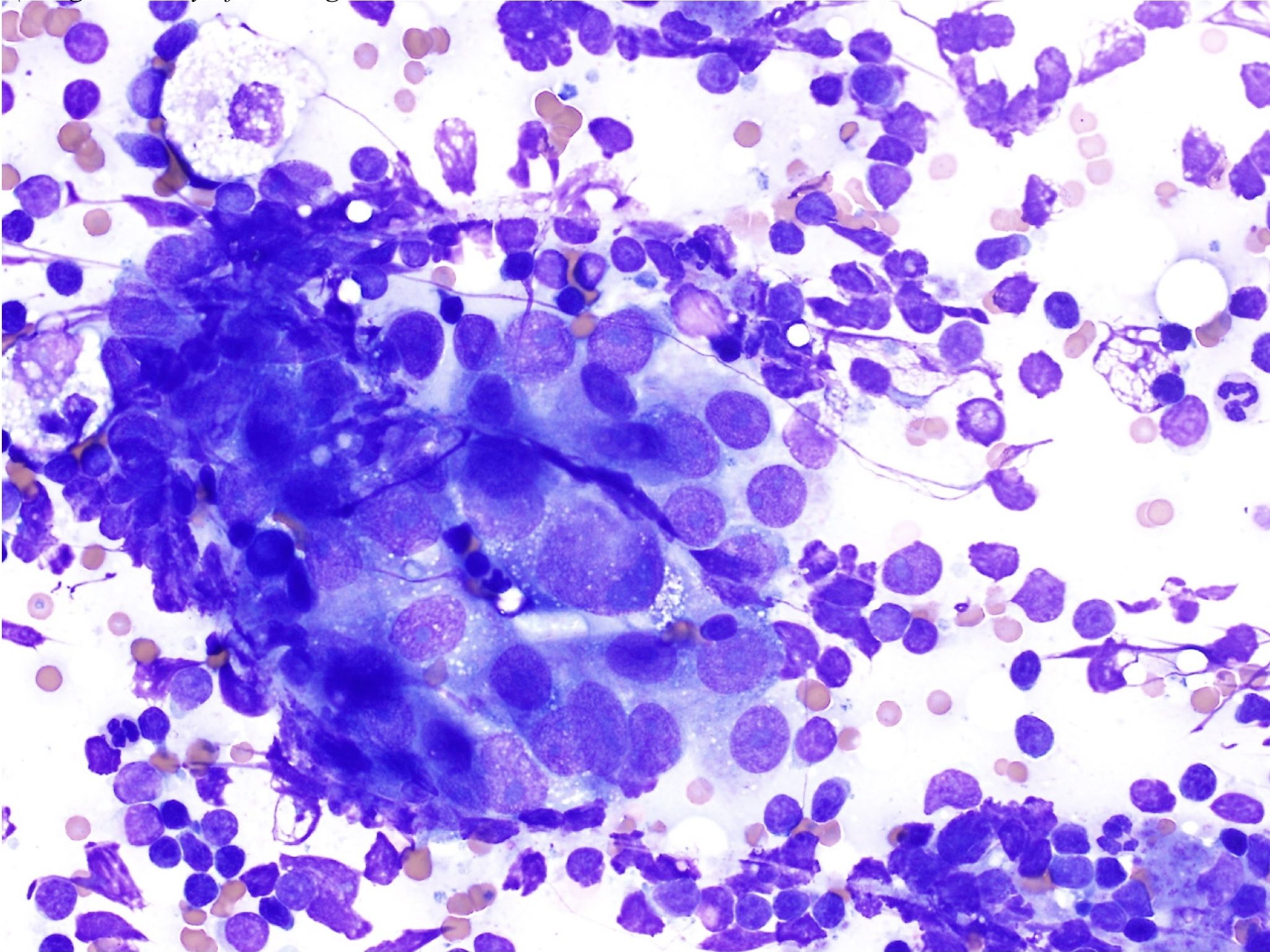 Figure 5.29 Metastatic carcinoma cells in a fine needle sample from an enlarged lymph node. Cells have features of malignancy in addition to being present in a lymph node. (Wright-Giemsa; HP oil.)(Image courtesy of Dr. Angelica Galezowski.)