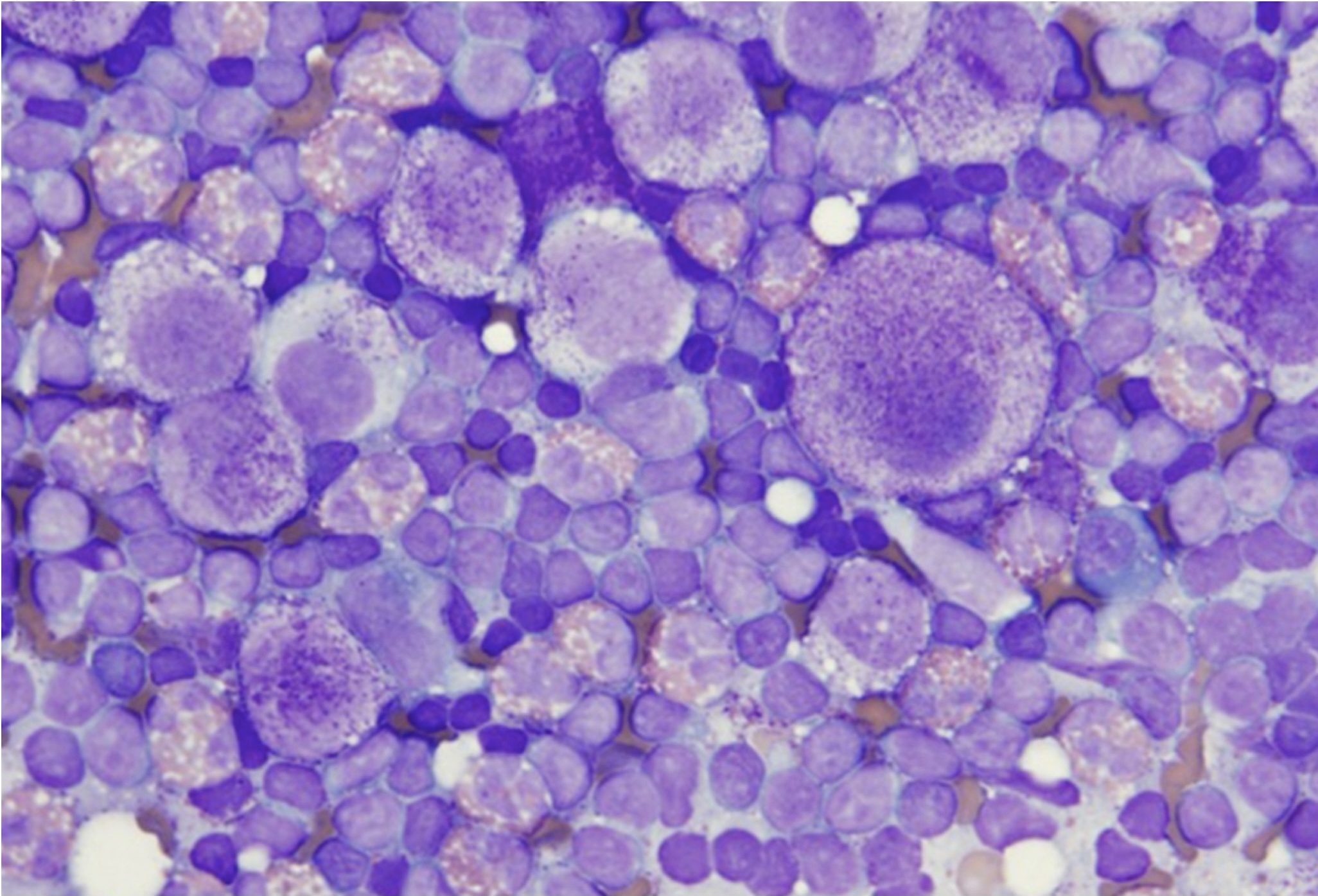 Figure 5.30 Metastatic mast cells in a fine needle sample from an enlarged lymph node. Mast cells are poorly granulated and display anisocytosis and anisokaryosis. Eosinophils are present as well.(Wright-Giemsa; HP oil.)