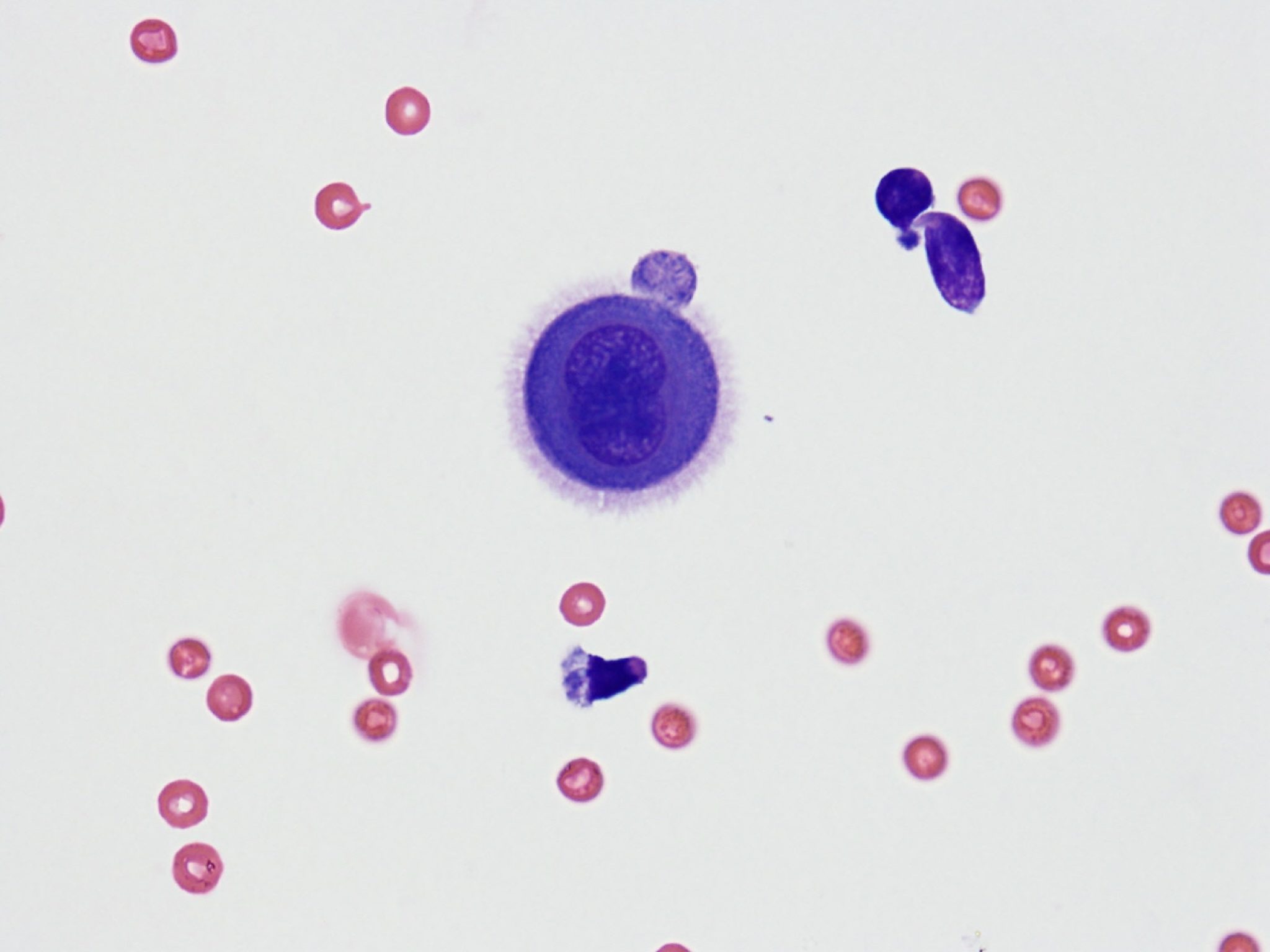 Figure 5.32 Mesothelial cell in a fluid cytology sample. Note pink corona typical of mesothelial cells.Reactive mesothelial cells may have atypical features such as multiple nuclei and prominent nucleoli. (Wright-Giemsa; HP oil.) (Image courtesy of Dr. Angelica Galezowski.)