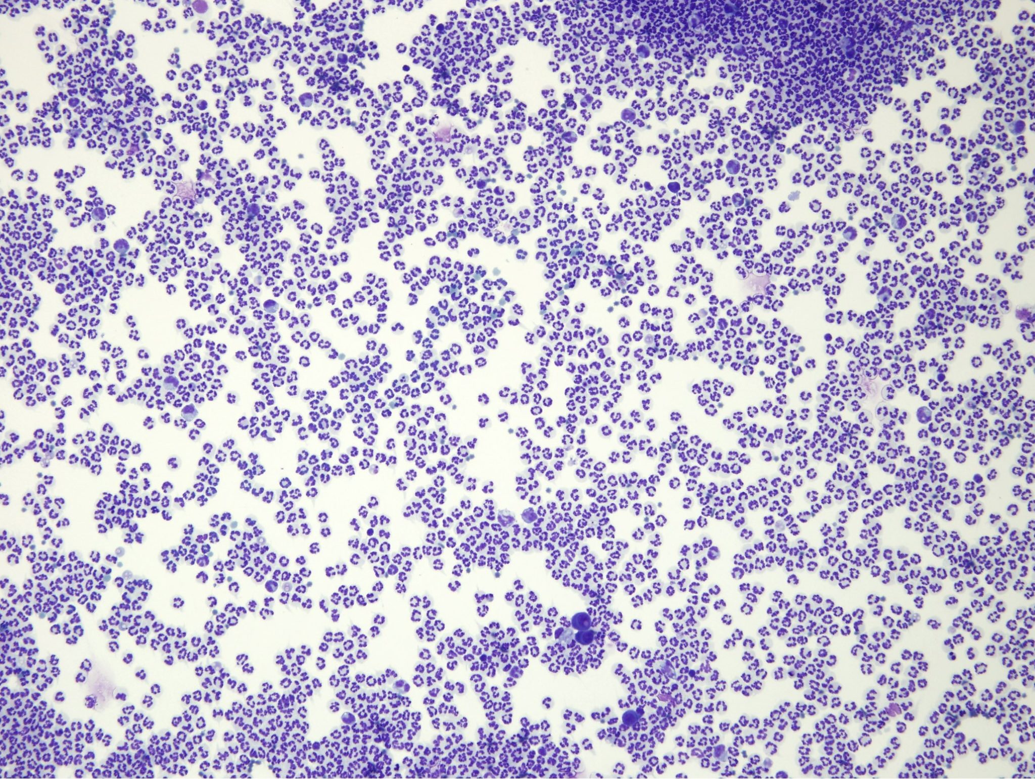 Figure 5.33 Direct smear of a nonseptic exudate. Note marked cellularity. Neutrophils are nondegenerate and no bacteria or other organisms are present. There are scant macrophages and mesothelial cells. (Wright-Giemsa; LP.)