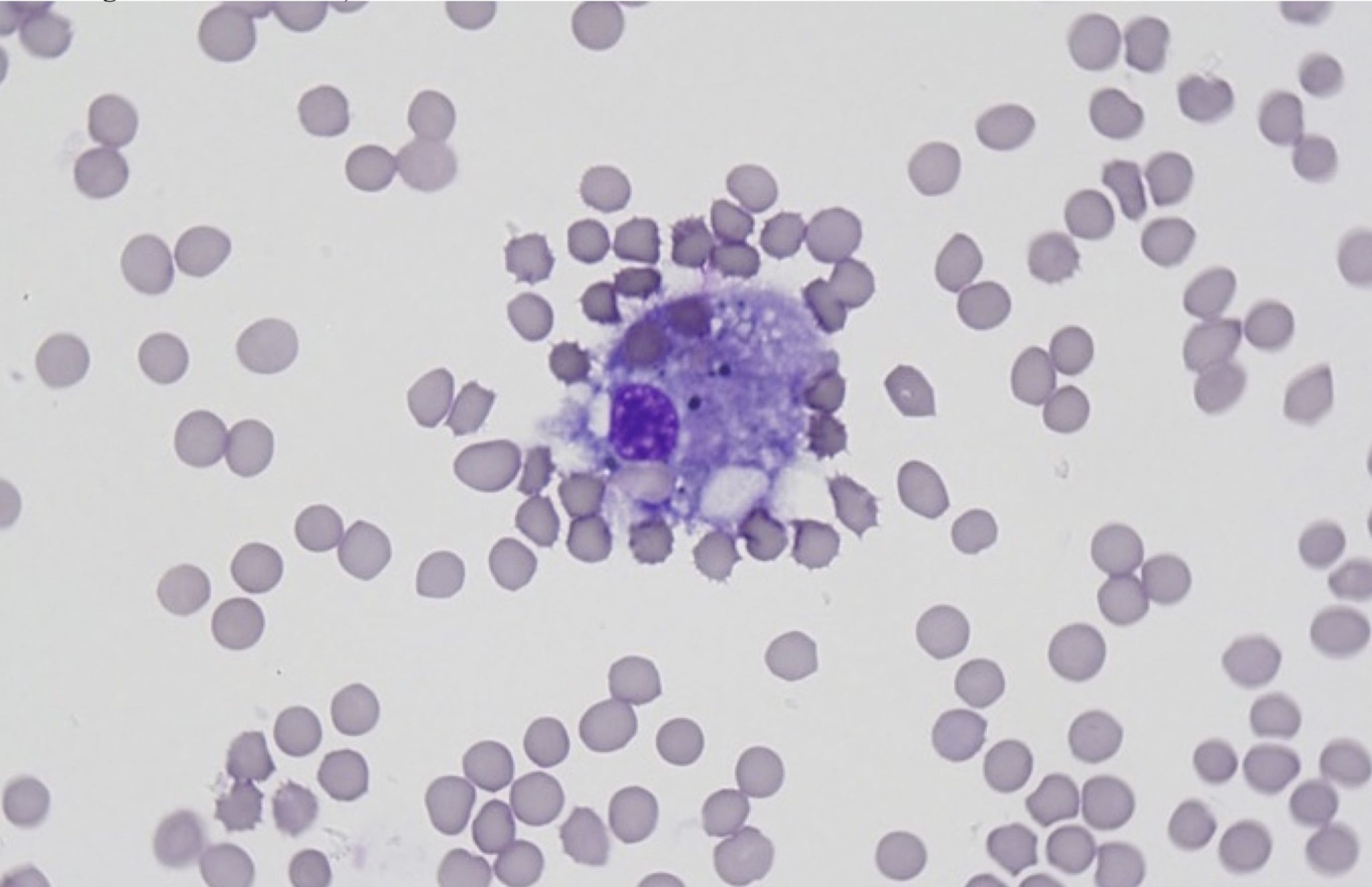 Figure 5.34 Hemorrhagic effusion. Note erythrophagia. (Wright-Giemsa; HP oil.) (Image courtesy of Dr. Angelica Galezowski.)