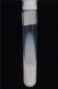 Figure 5.35 Chylous effusion (gross). Note milky appearance of the fluid.