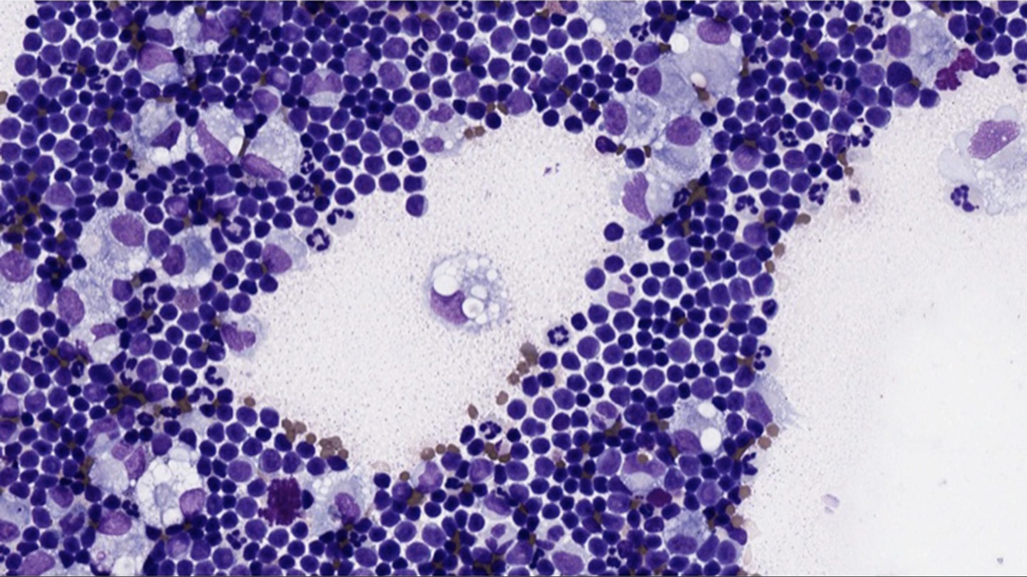 Figure 5.36 Chylous effusion (cytospin). There are numerous small lymphocytes and large foamy macrophages. (Wright-Giemsa; IP.)