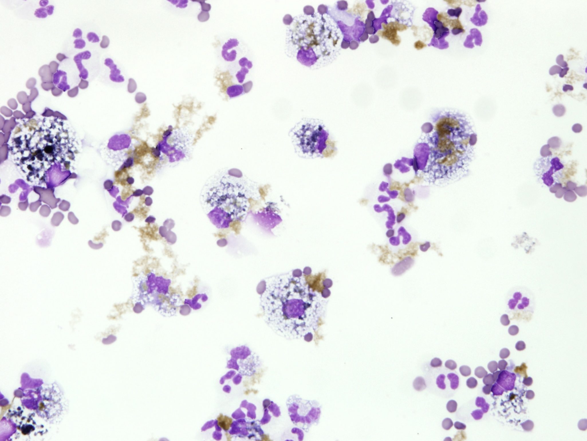 Figure 5.39 Bile peritonitis. This fluid is a nonseptic exudate secondary to bile leakage. Note yellow bile pigment in the background and within macrophages. (Wright-Giemsa; HP oil.)