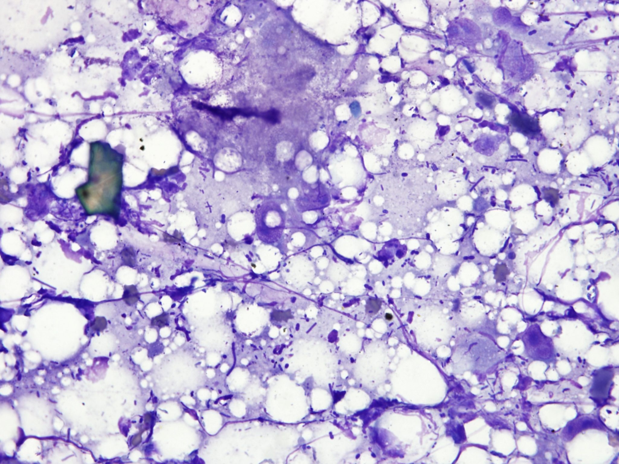 Figure 5.40 Gut tap. Note numerous bacteria with debris. (Wright-Giemsa; HP oil.)