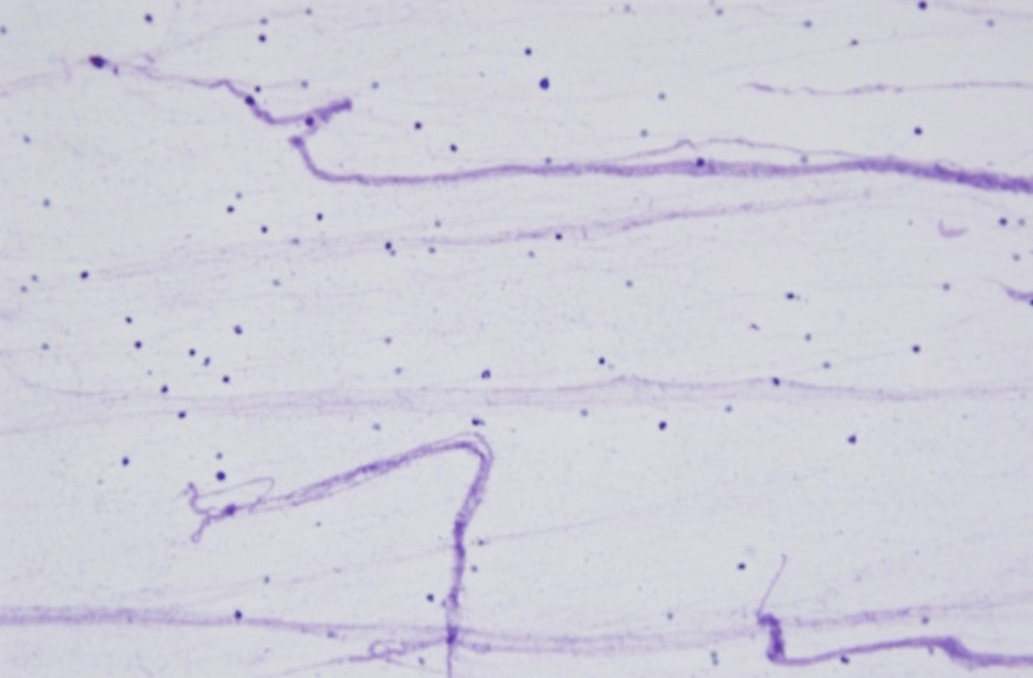 Figure 5.44 Normal synovial fluid. Note low cellularity and strands of mucin in the background. (Wright-Giemsa; LP.) (Image courtesy of Dr. Angelica Galezowski.)