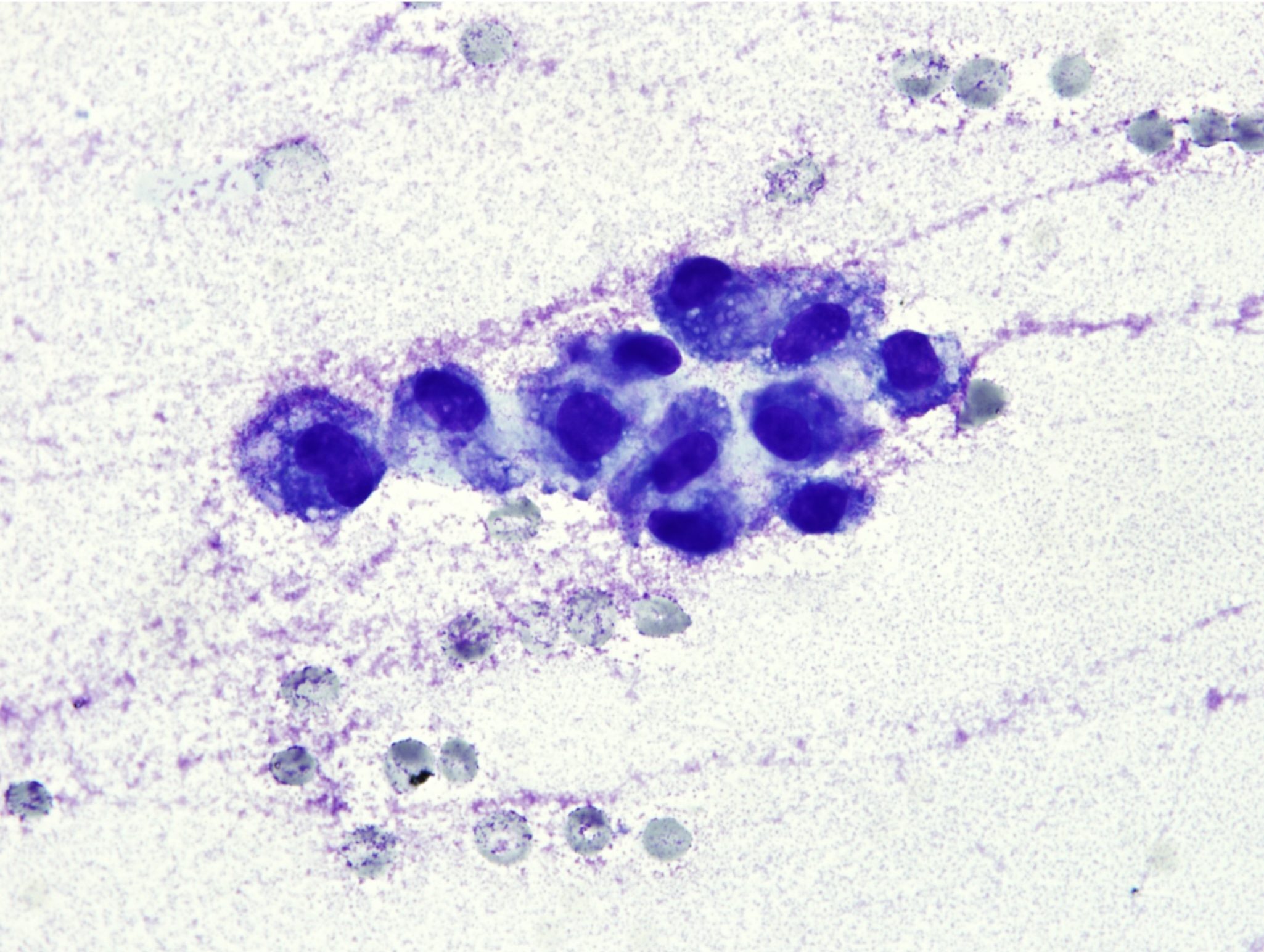 Figure 5.45 Synovial fluid- degenerative joint disease. There are increased numbers of mononuclear cells. (Wright-Giemsa; HP oil.)