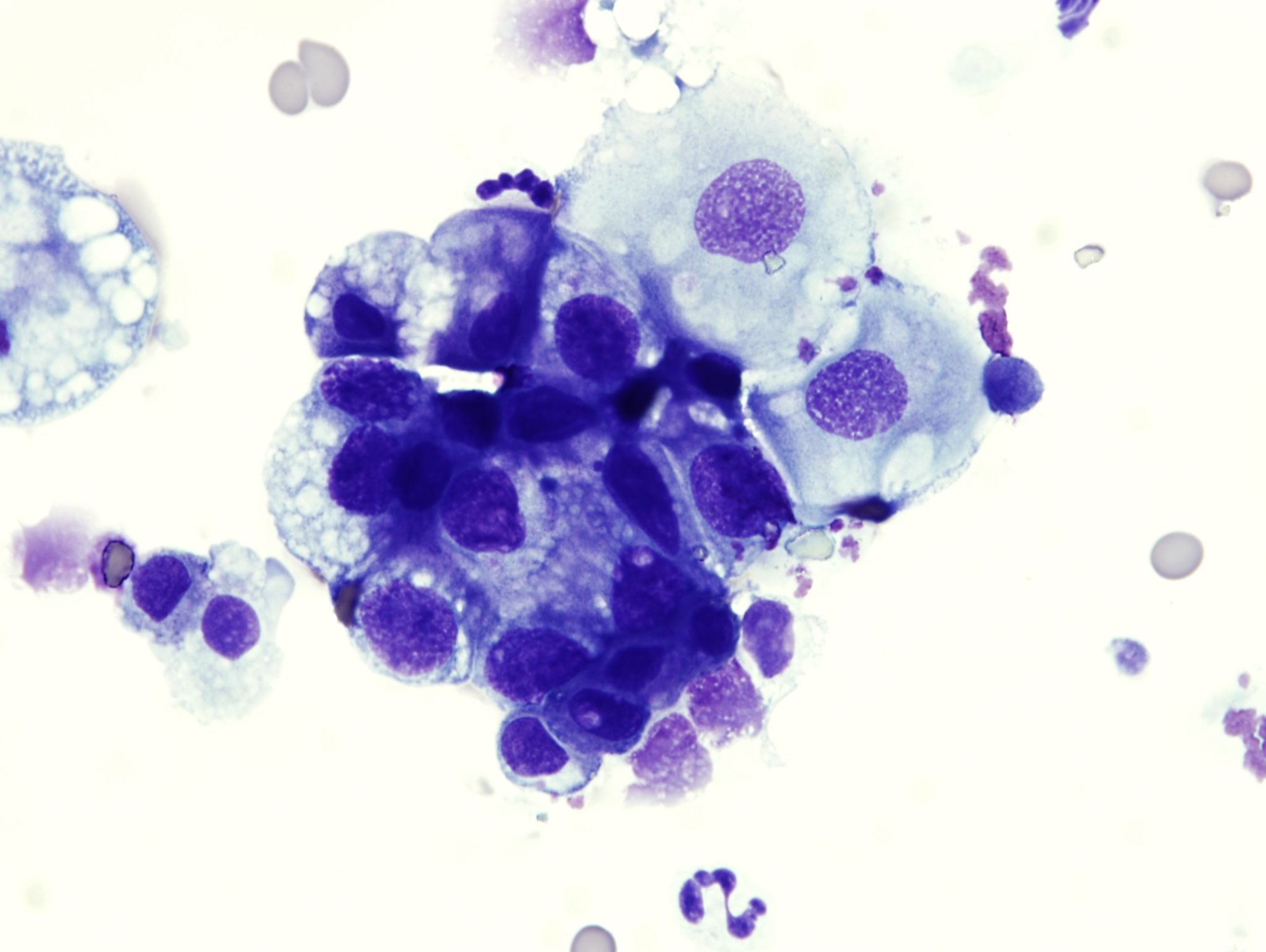 Figure 5.56a Case 10: Fluid samples from traumatic catheterization of a bladder mass from a dog. Please see text for description and interpretation. (Wright-Giemsa; HP oil.)