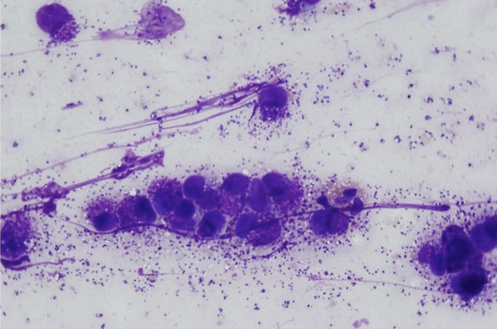 Figure 5.6 Mast cells. Cells have numerous purple cytoplasmic granules. There is a single eosinophil. (Wright-Giemsa; HP oil.) (Image courtesy of Dr. Angelica Galezowski.)