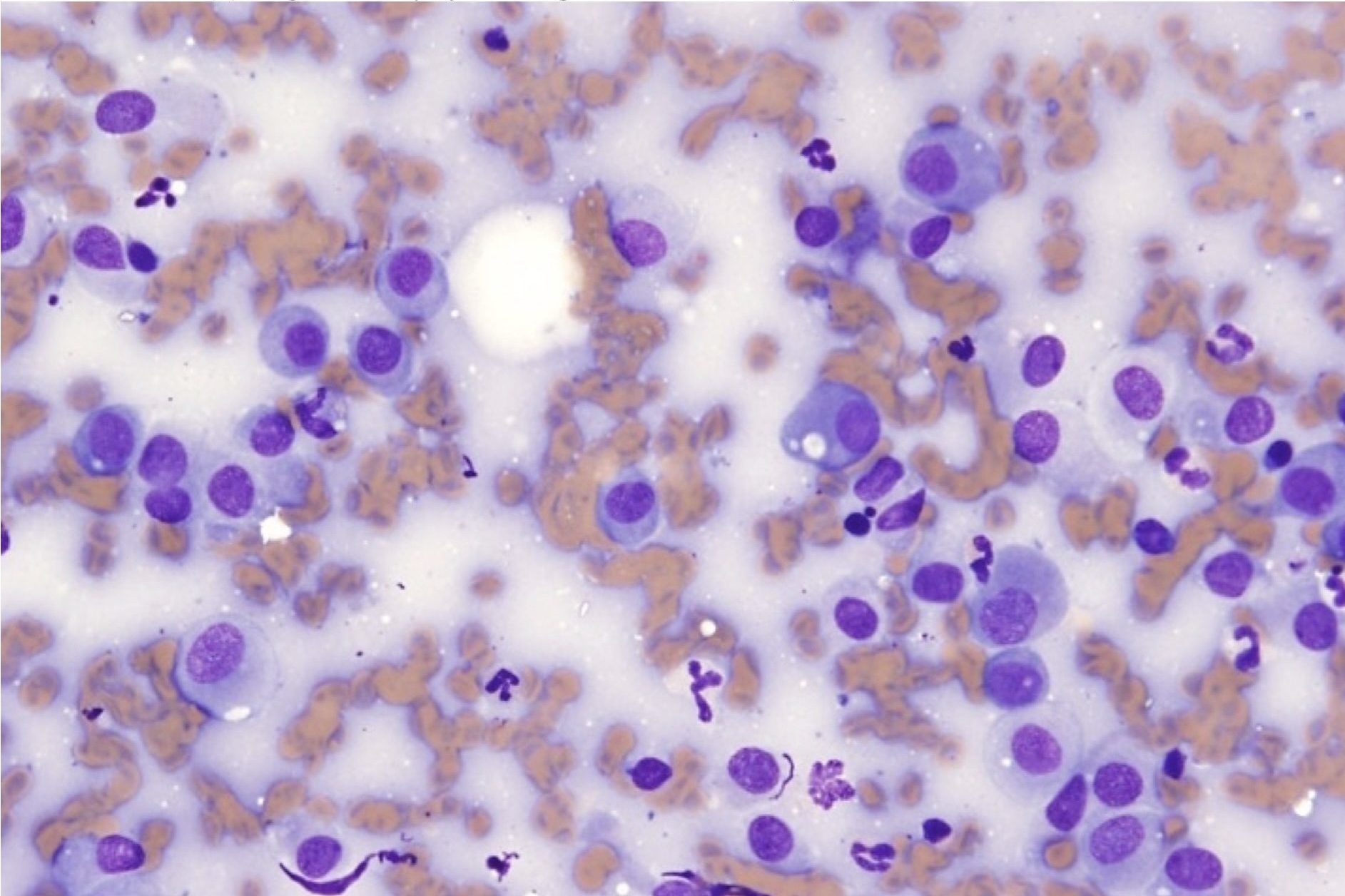 Figure 5.7 Plasma cells. Cells have eccentric nuclei and a clear Golgi zone may be visible. (Wright-Giemsa; HP oil.) (Image courtesy of Dr. Angelica Galezowski.)