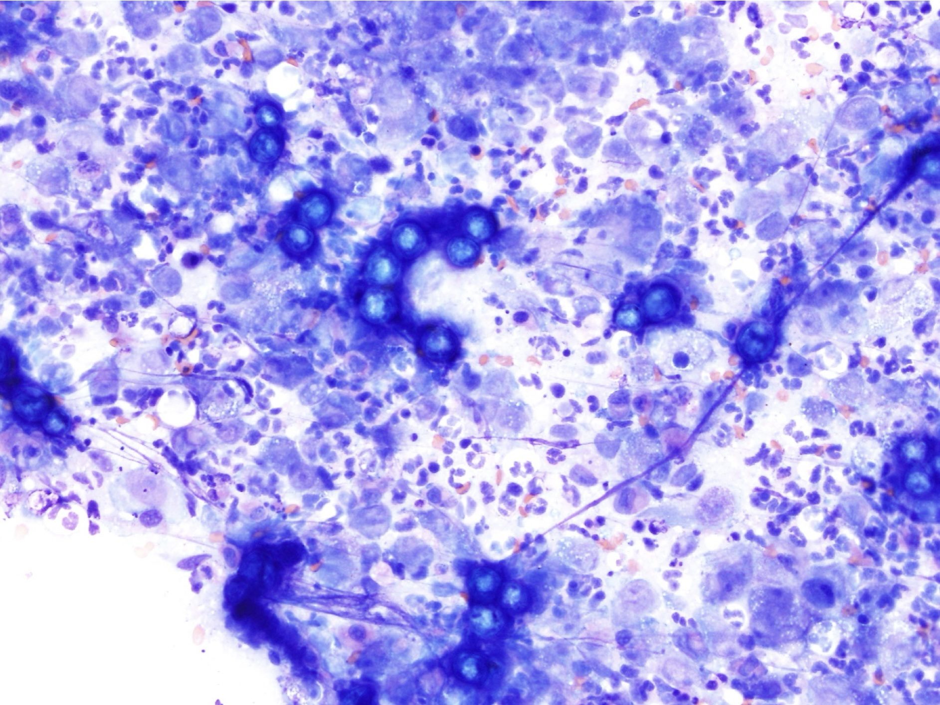 Figure 5.9 Mixed neutrophilic and macrophagic inflammation. The inflammation is secondary to blastomycosis (blue spherical structures are fungal organisms). (Wright-Giemsa; IP.) (Image courtesy of Dr. Angelica Galezowski.)