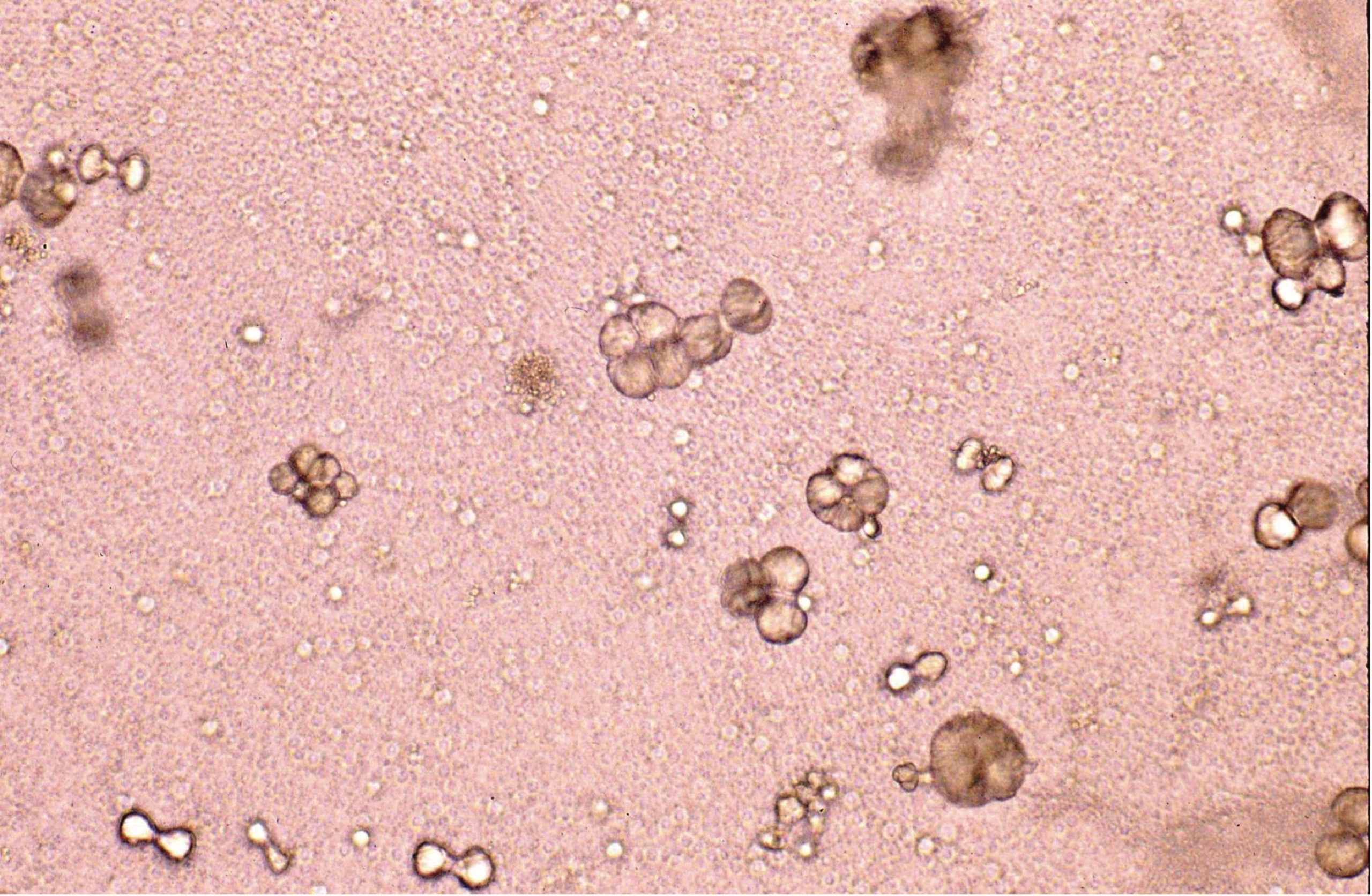 Figure 7.10 Urine sediment, unstained. Calcium carbonate crystals. May be spherical to dumbbell-shaped.