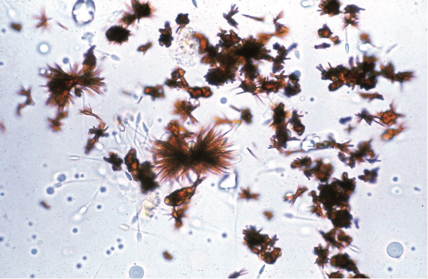 Figure 7.11 Urine sediment, unstained. Bilirubin crystals. These are yellow-brown. Note also spermatozoa.