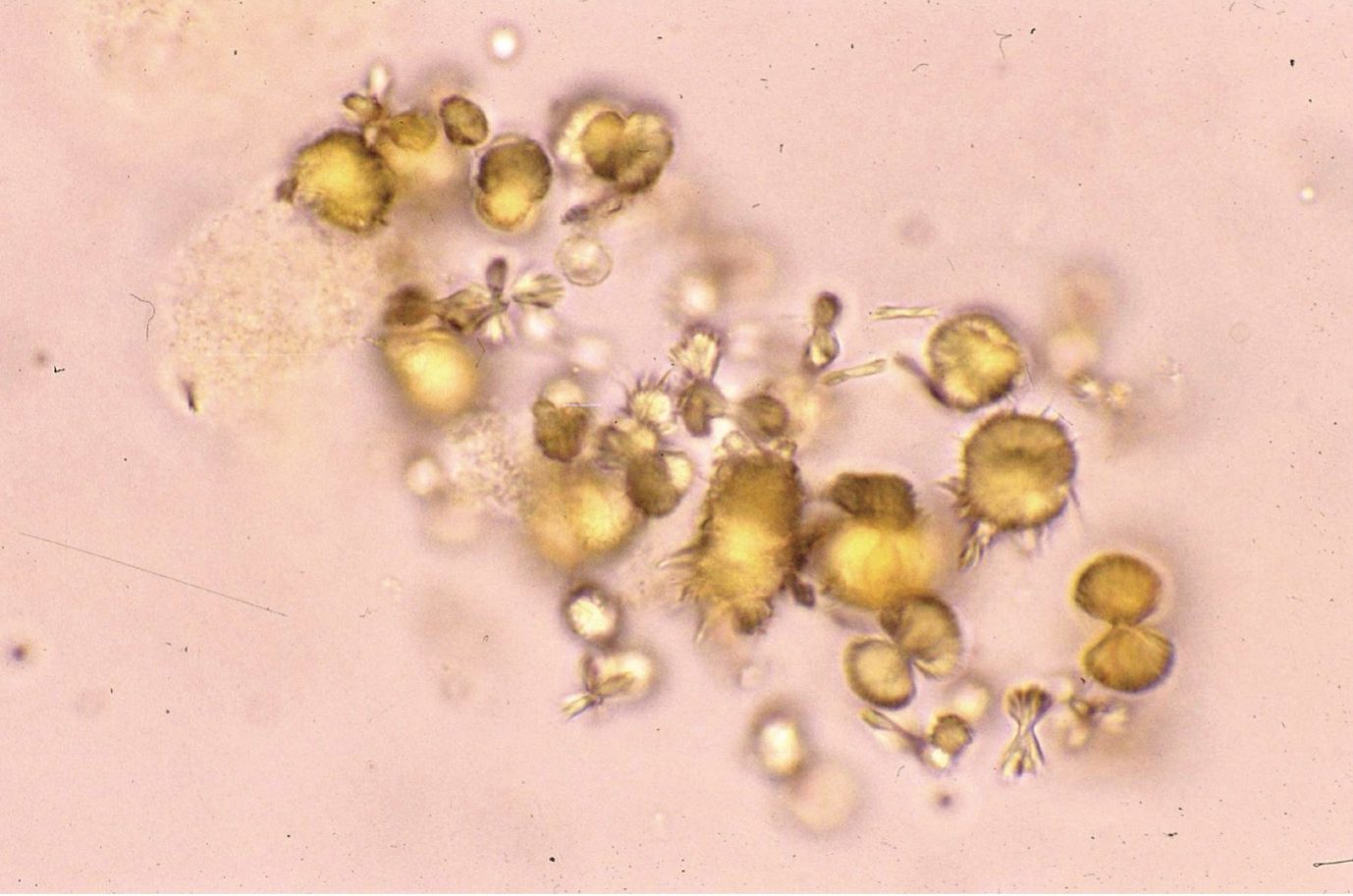 Figure 7.12 Urine sediment, unstained. Ammonium biurate (round with spikes) and urate crystals.