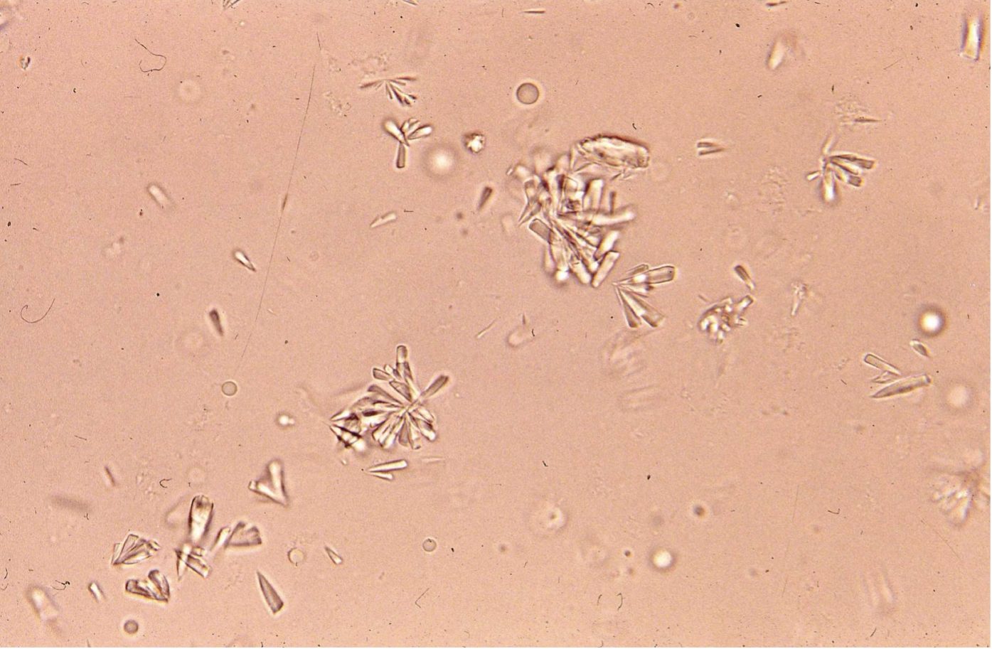 Figure 7.13 Urine sediment, unstained. Calcium phosphate crystals.