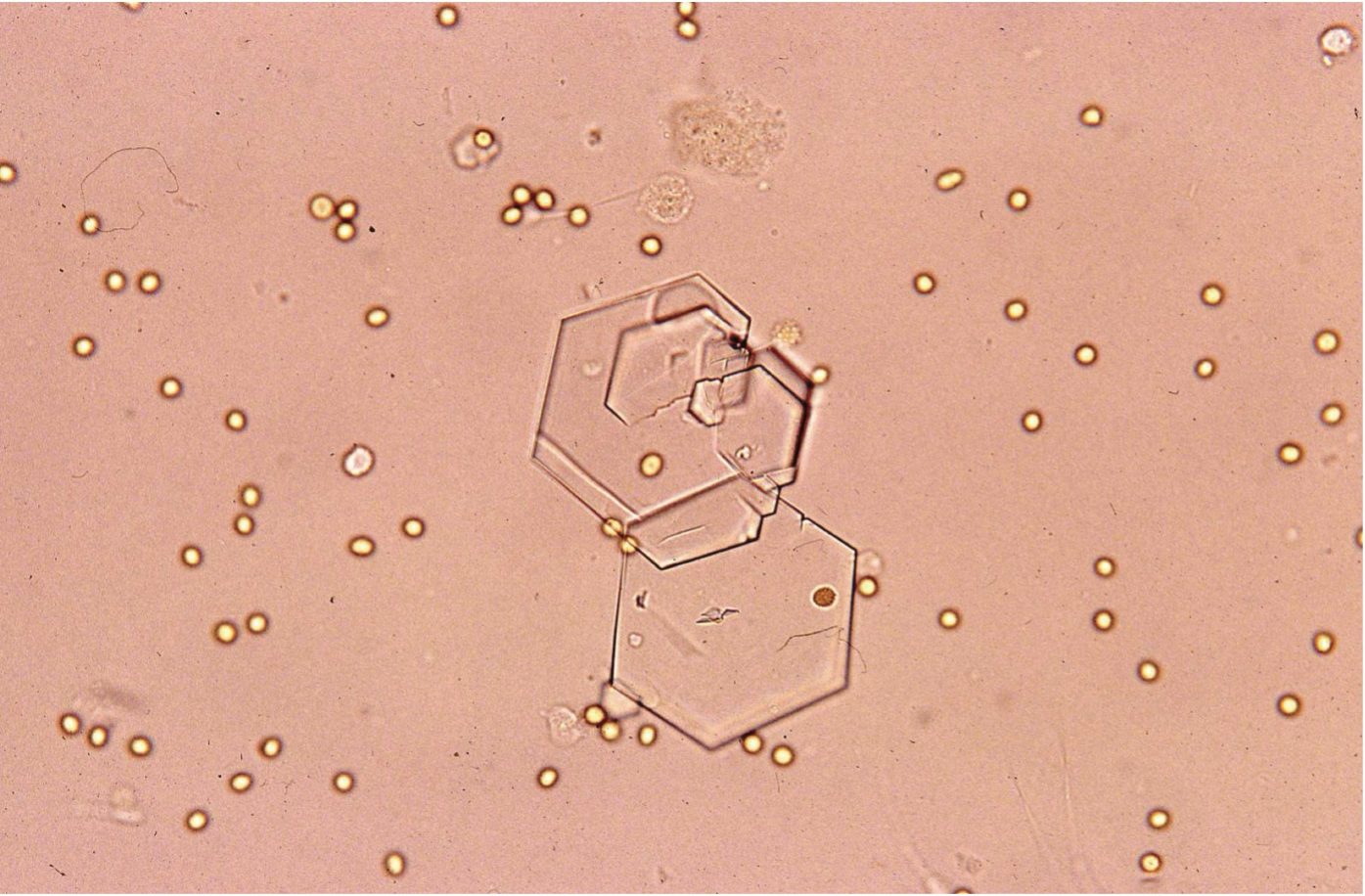 Figure 7.14 Urine sediment, unstained. Cystine crystals.