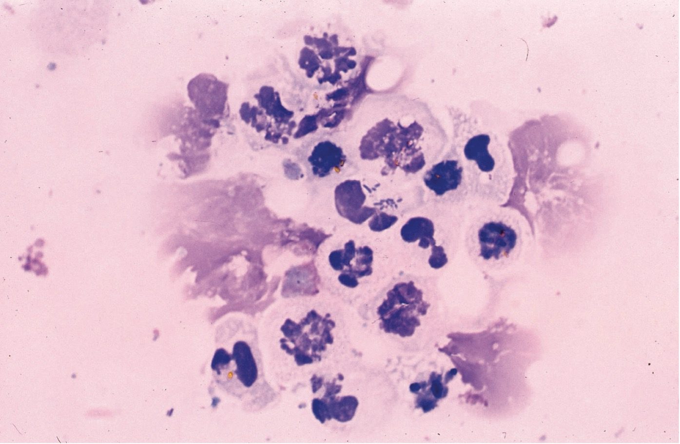 Figure 7.15 Urine sediment, Wright-Giemsa. Degenerate neutrophils. Intracellular rods are present in the central neutrophil.