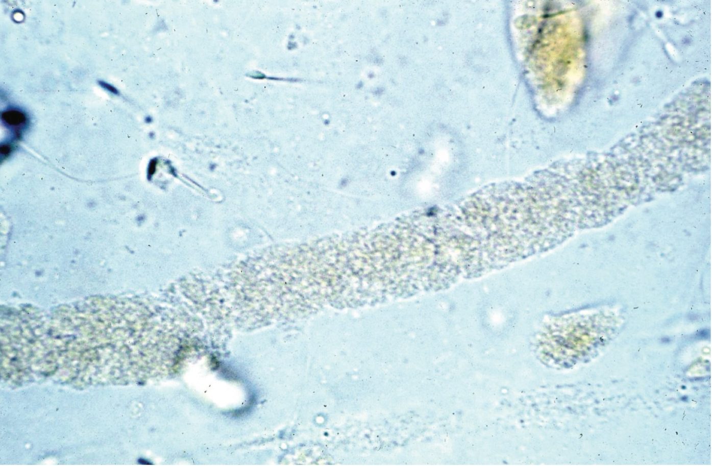 Figure 7.16 Urine sediment, unstained. Granular cast.