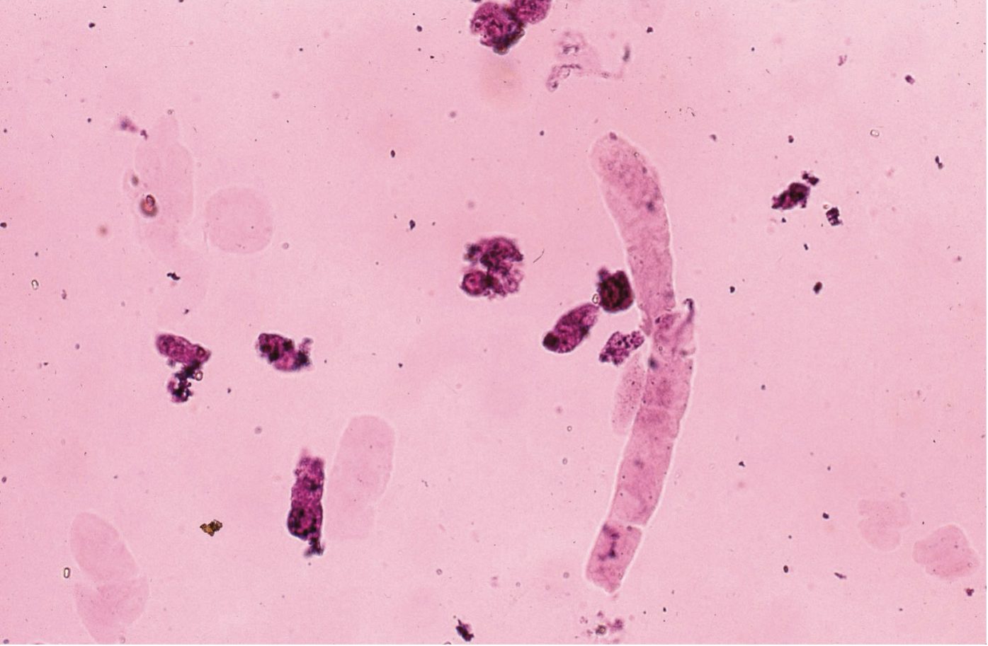 Figure 7.17 Urine sediment, sedistain. Hyaline cast.