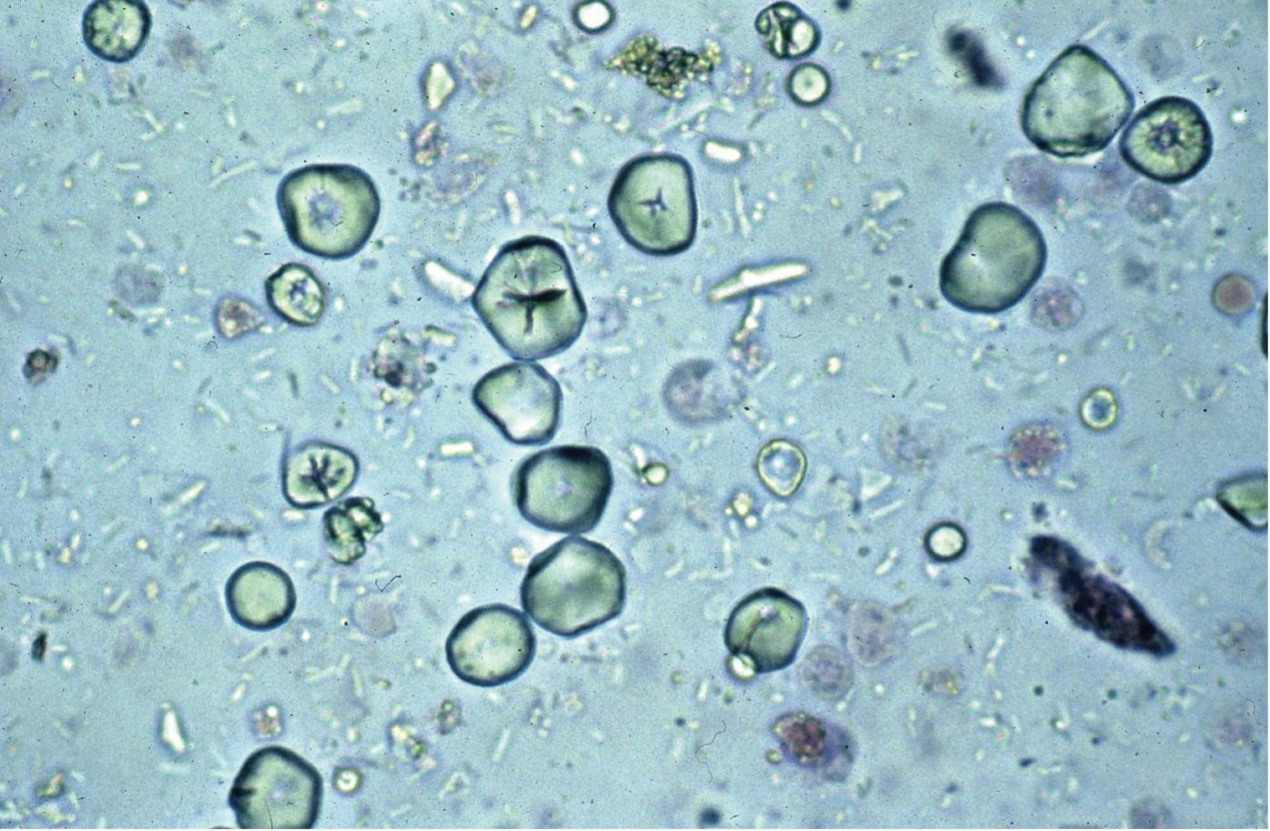 Figure 7.18 Urine sediment, sedistain. Starch granules (artifact), from glove powder.