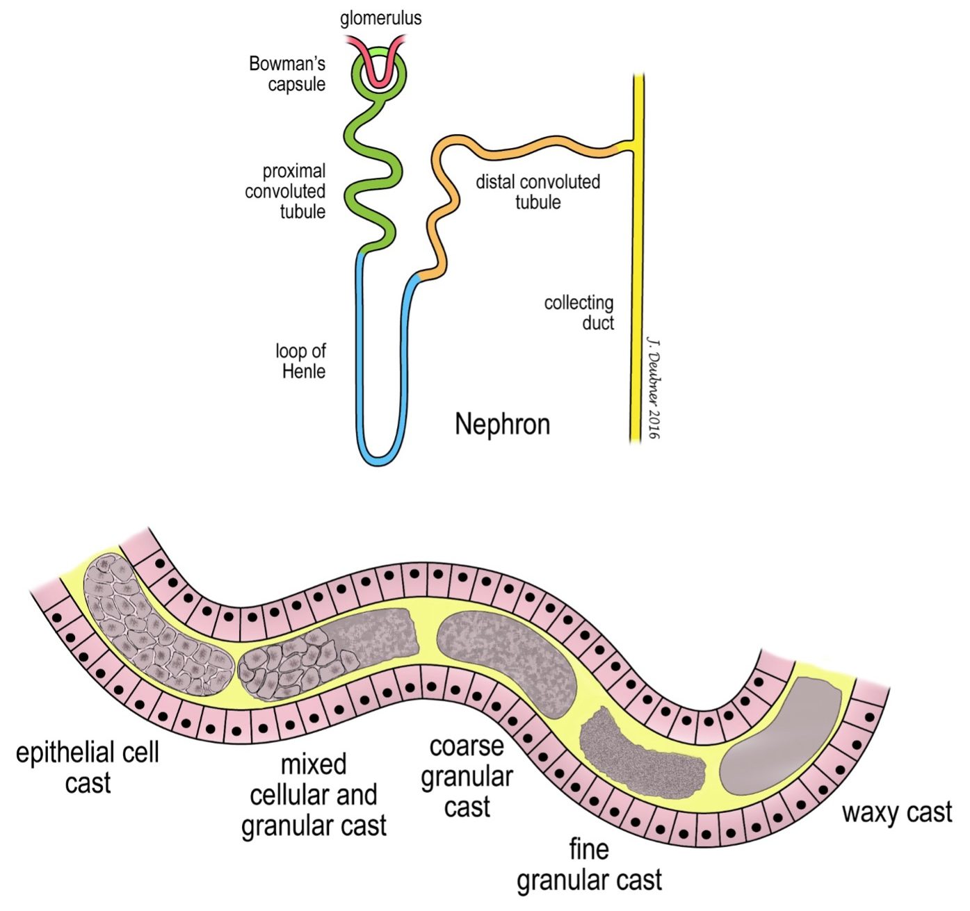 Figure 7.2. Mechanism of cast formation: transition between epithelial cell, coarse, fine granular, and waxy casts formed in the loop of Henle, distal tubules and collecting ducts.