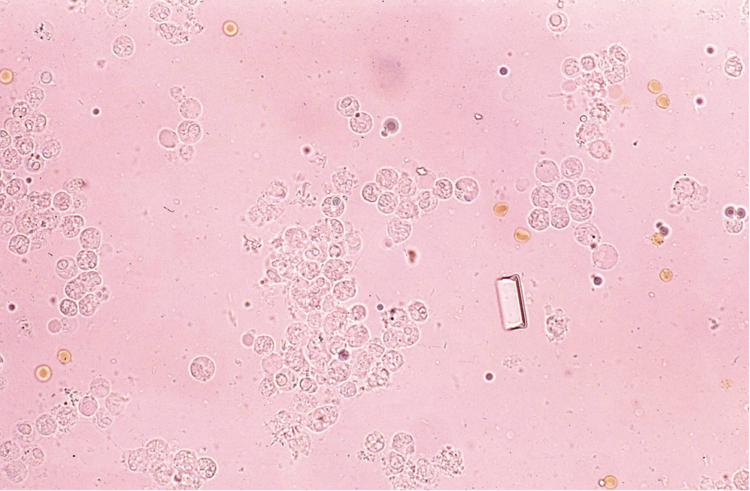 Figure 7.3 Urine sediment, unstained. Numerous leukocytes and erythrocytes; single struvite crystal.