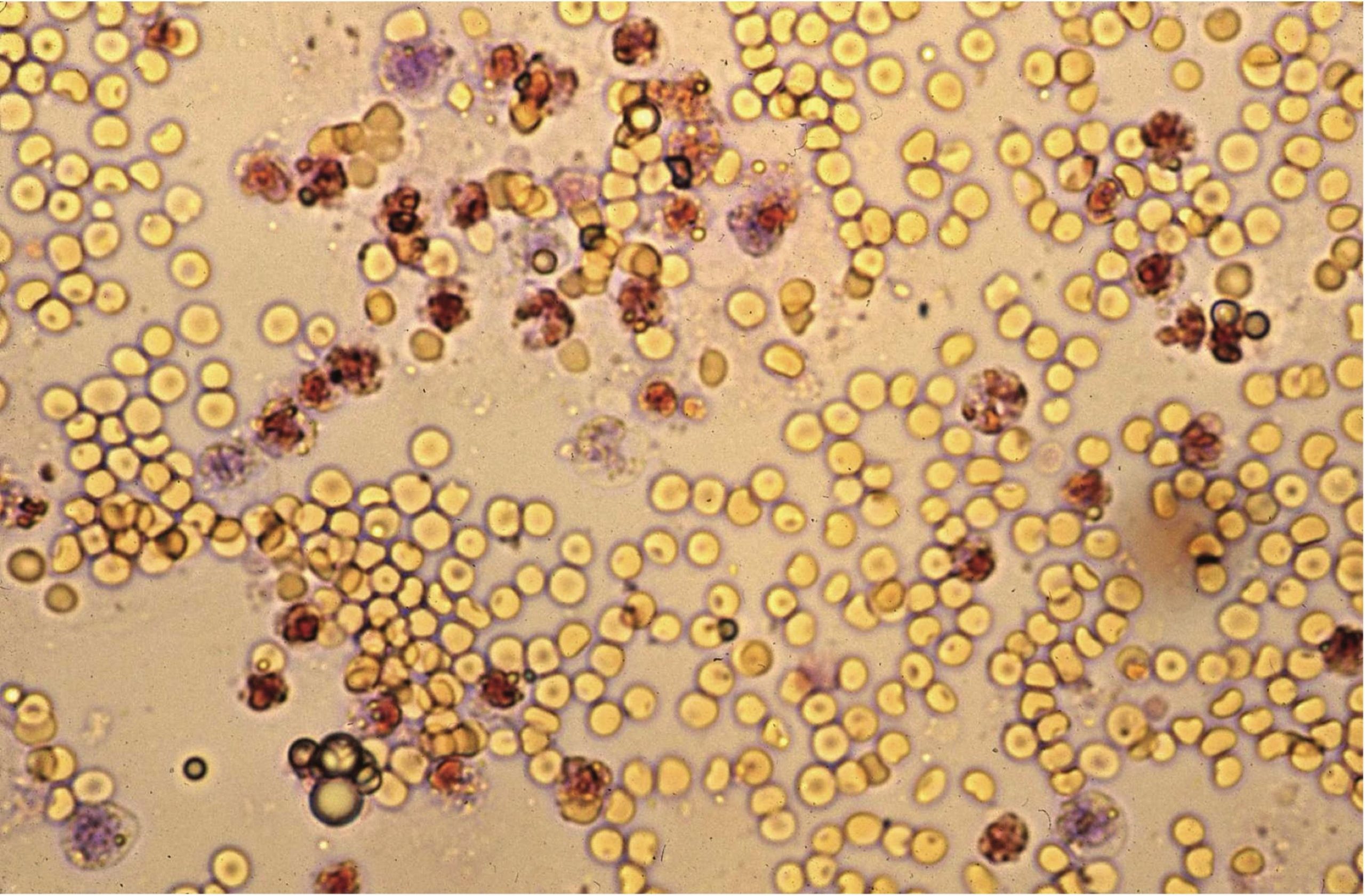 Figure 7.4 Urine sediment, sedistain. Numerous erythrocytes and leukocytes.