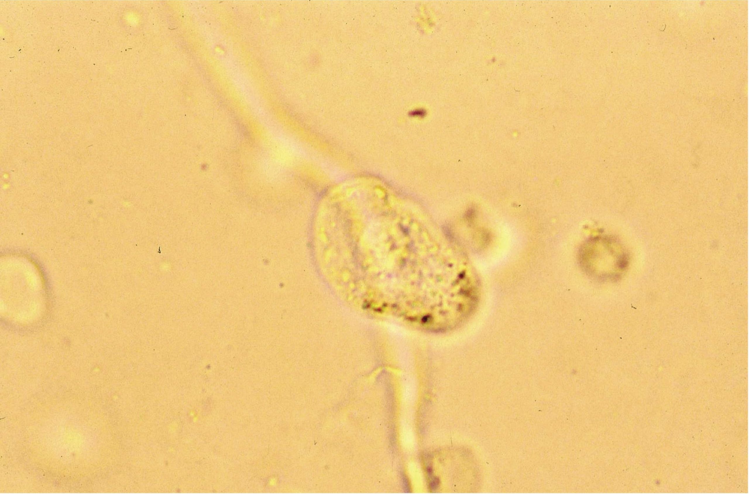 Figure 7.5 Urine sediment, unstained. Squamous epithelial cell.